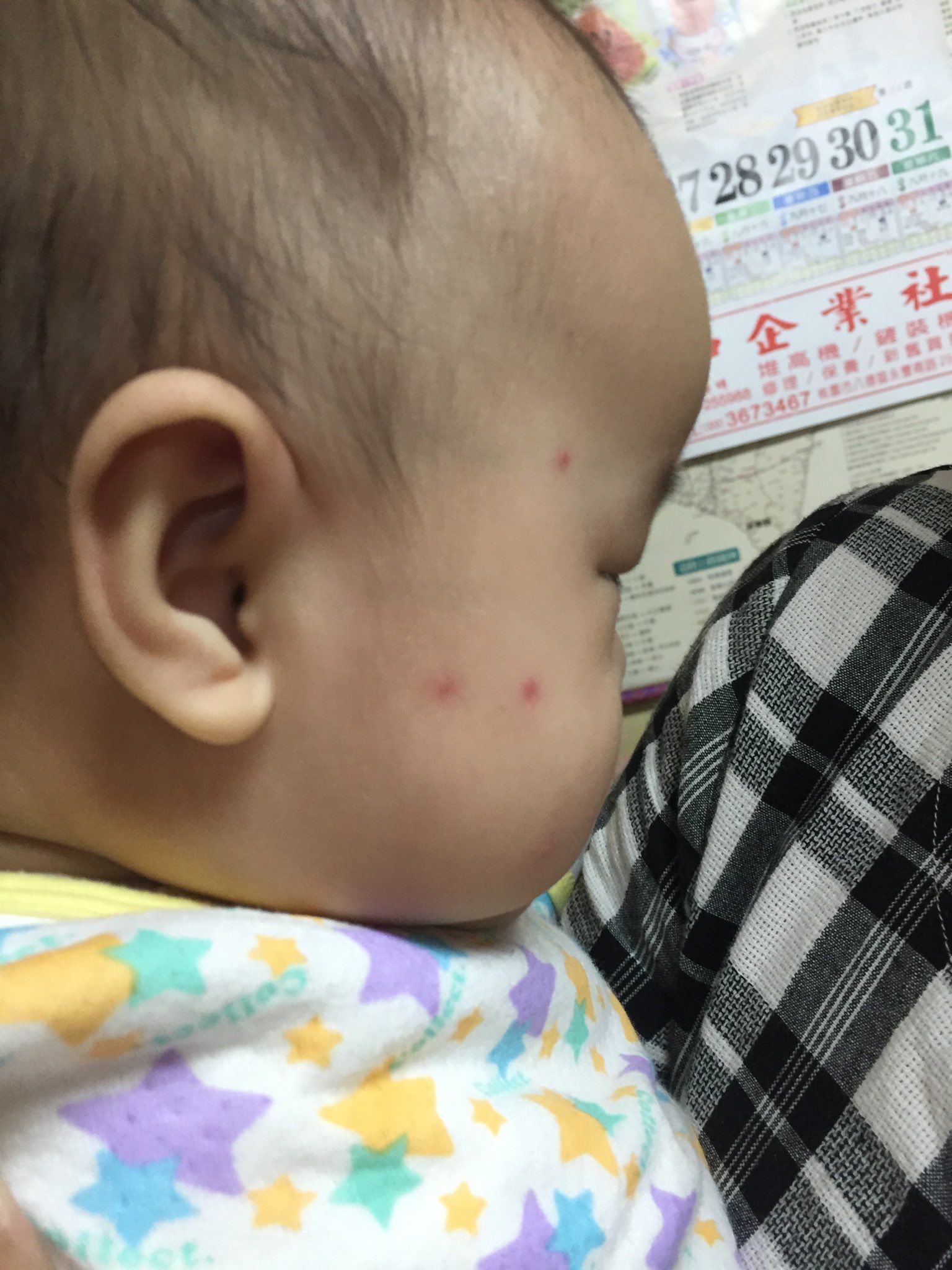 蚊子叮咬