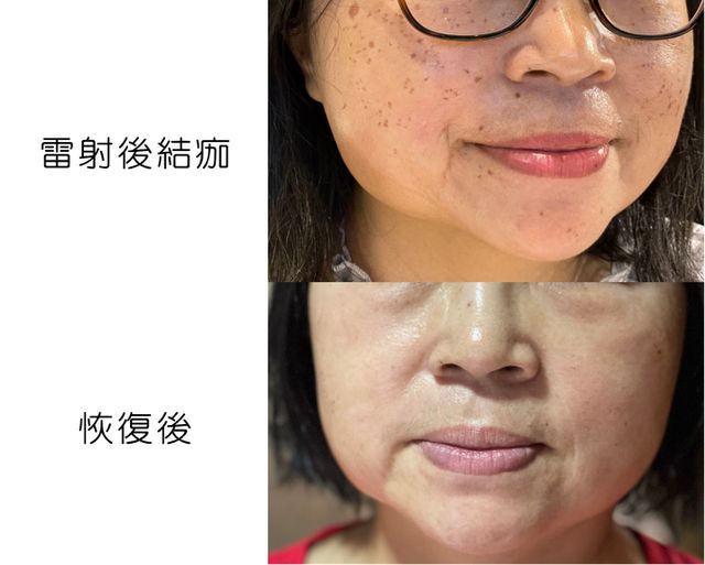 在中和雅文皮膚科 給黃千耀醫師打過picocare 去深色斑效果還頗好的