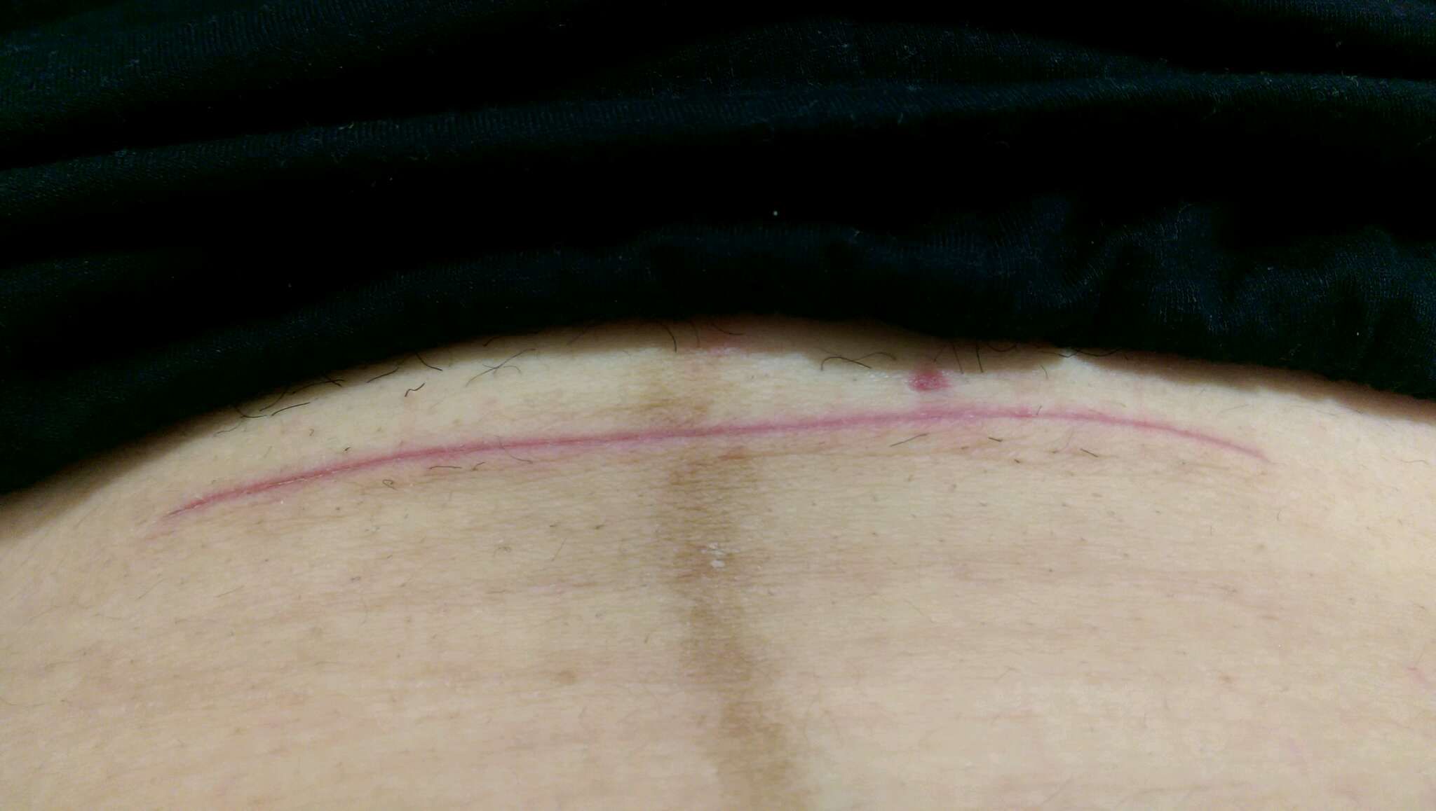 想請問剖腹傷口這樣正常嗎？