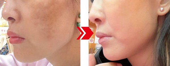 推薦長虹診所雪白聯合 去除我多年的惱人的各種斑