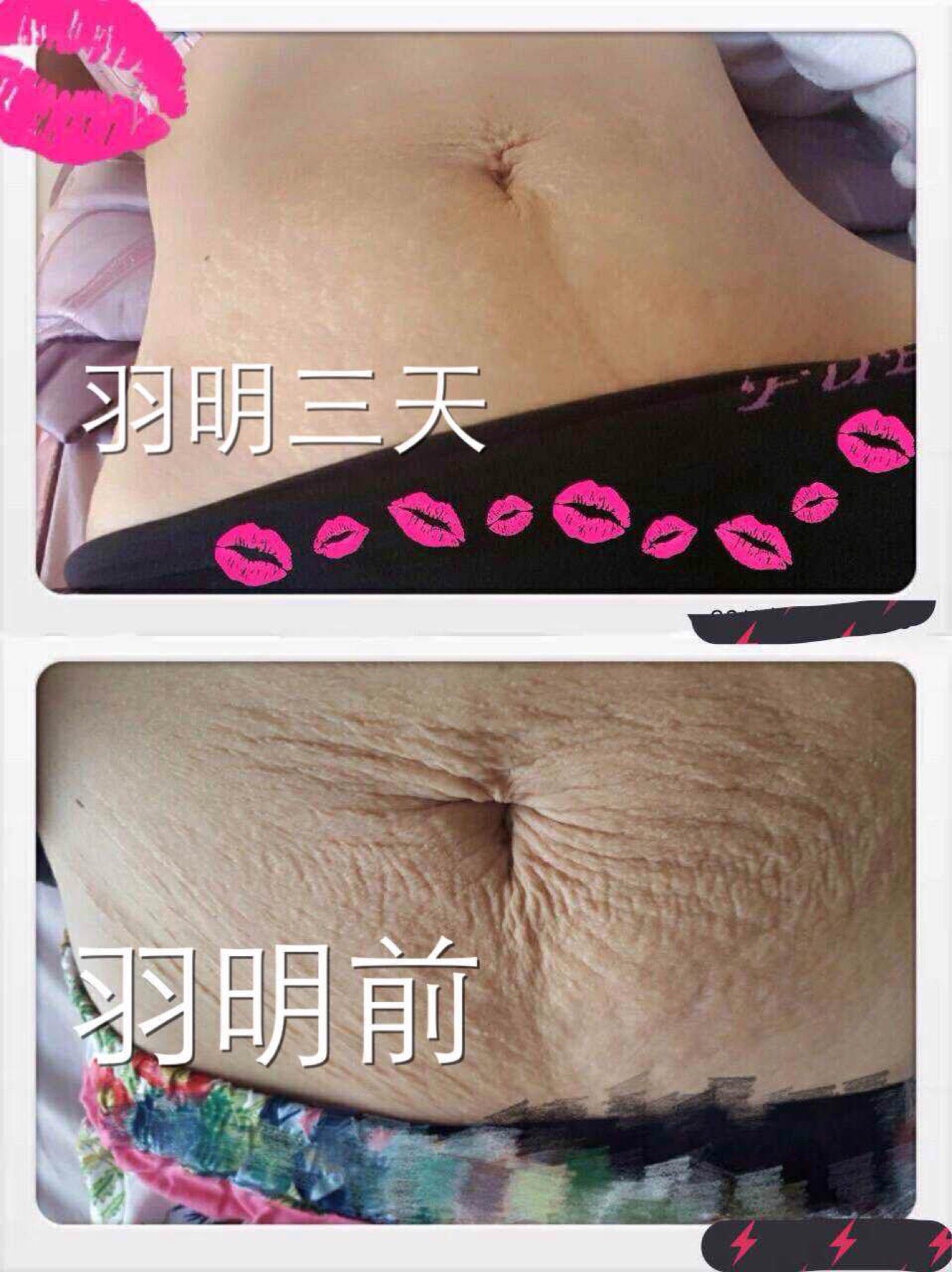 妊娠紋、肥胖紋、疤痕困擾你多年了？