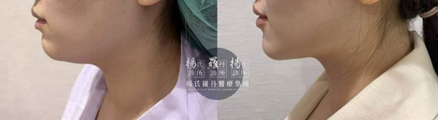 我也是雙下巴很明顯,做了很久功課才決定去楊氏診所找醫師諮詢,後來做完抽脂真的差很多,恢復期前幾天會有點腫脹不過傷口很小,大約一個月左右效果更明顯,大家都說我臉部線條更好看了!