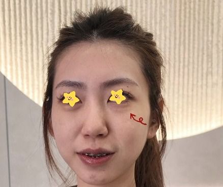 想請教美加醫美眼袋手術手法差異,有人做過嗎?