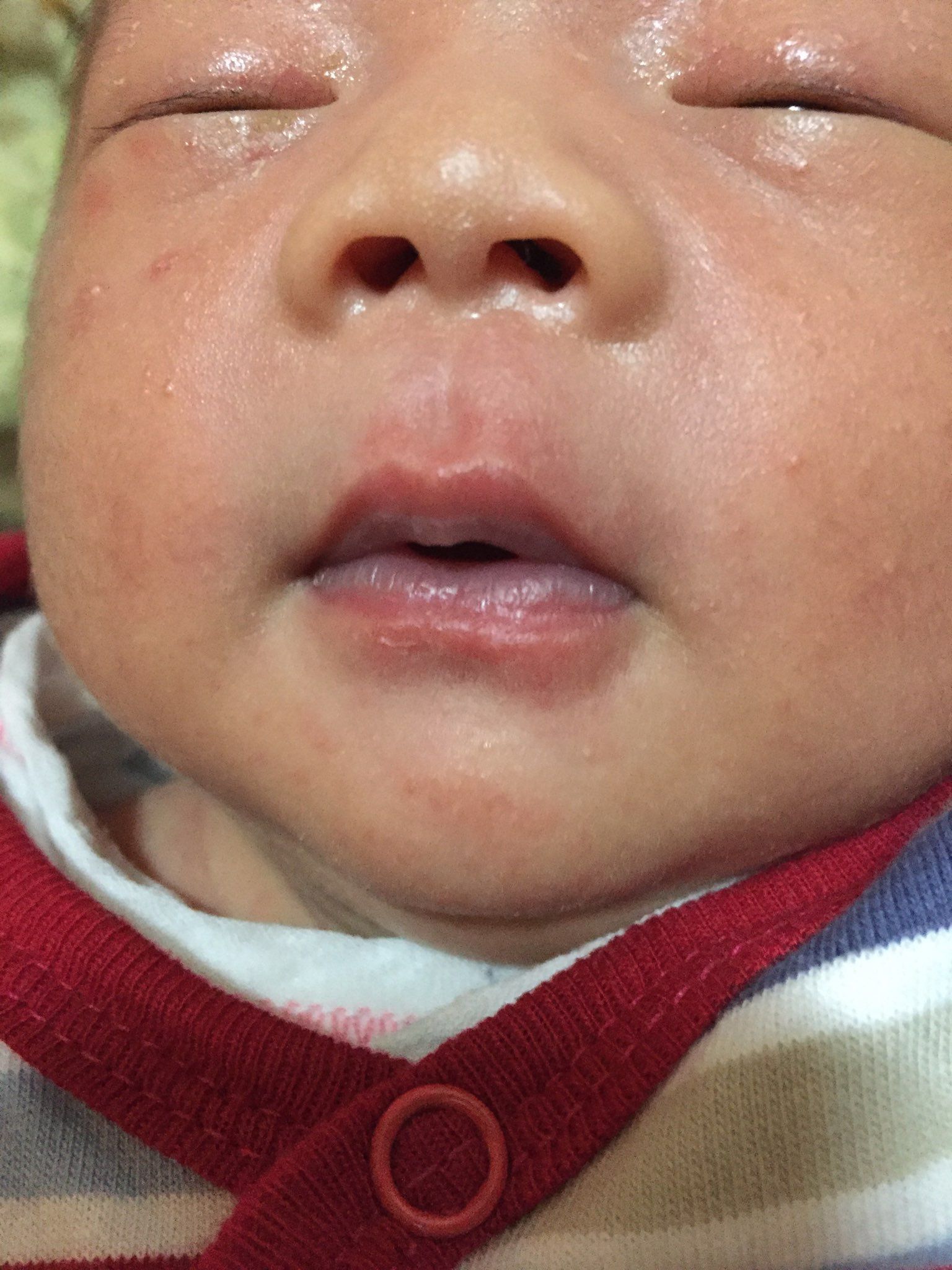 寶寶嘴唇一圈白白