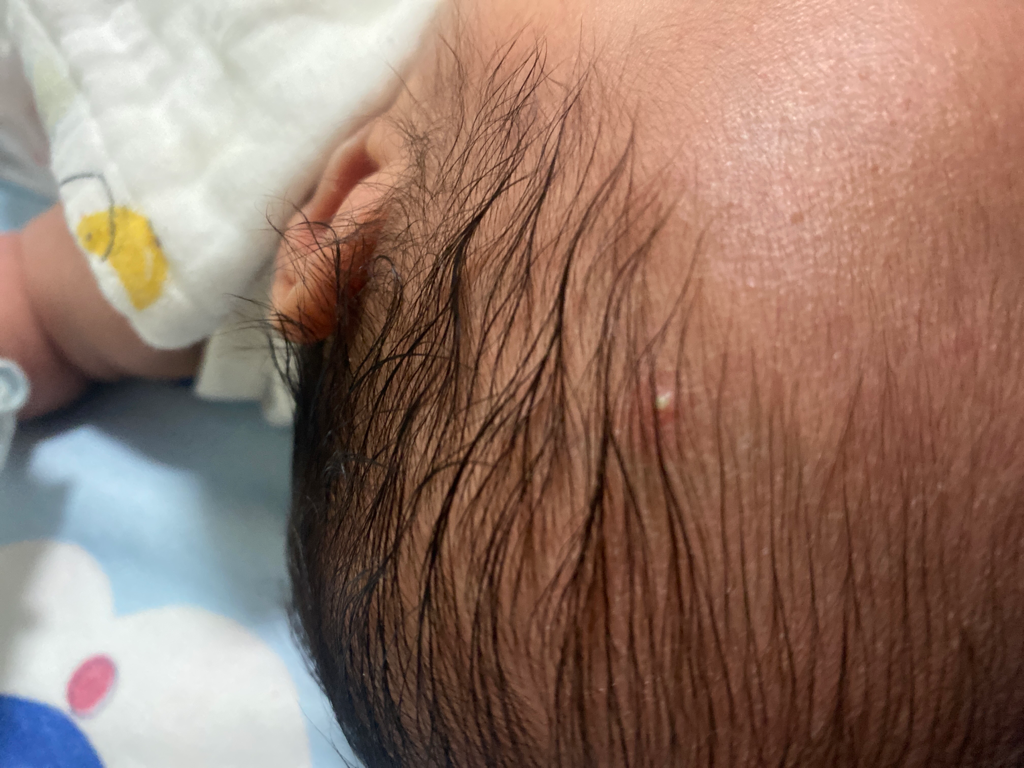 寶寶頭上多了好幾個膿包