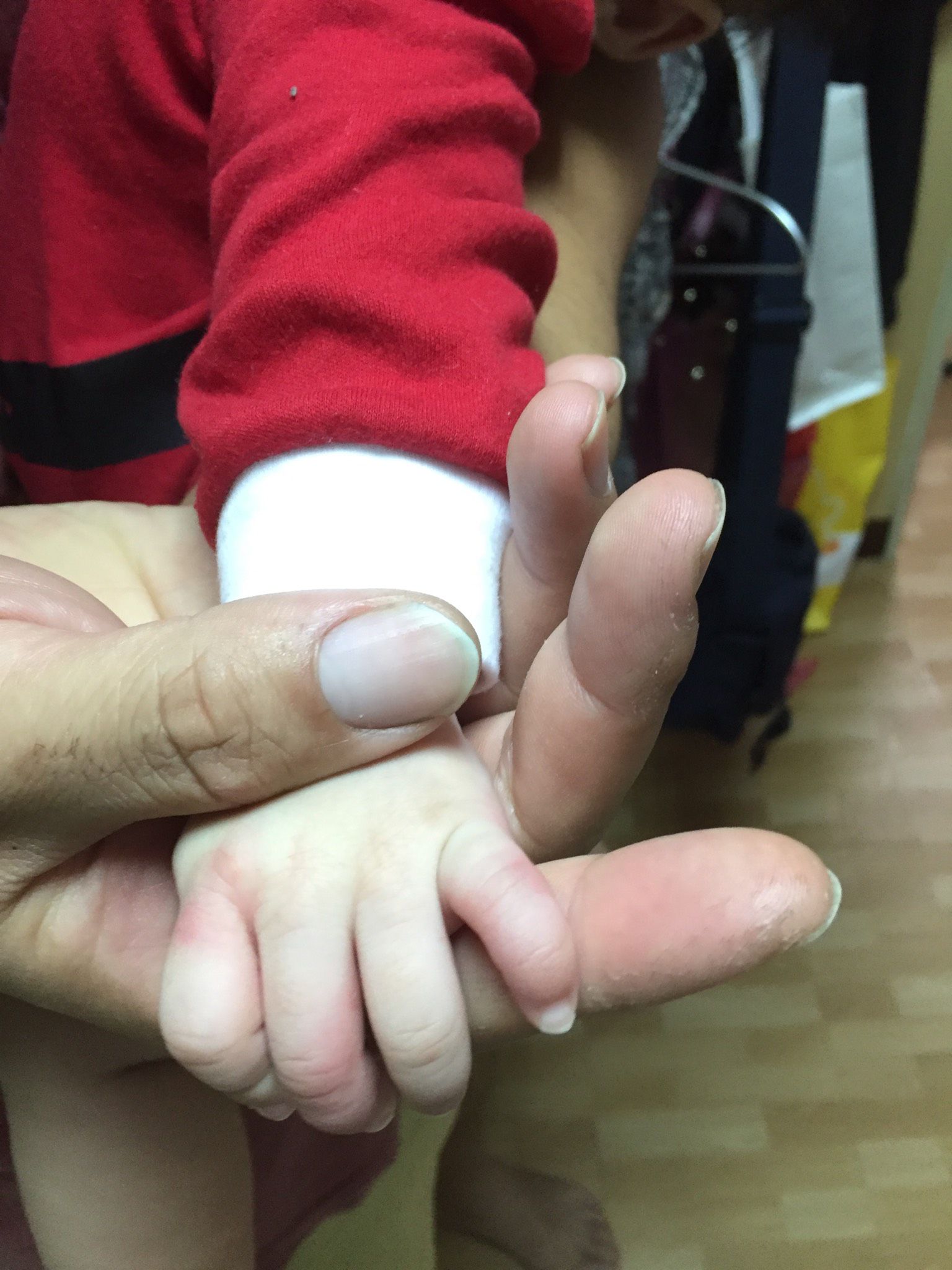 四個月寶寶頭手腳出現像蚊子叮的紅疱？