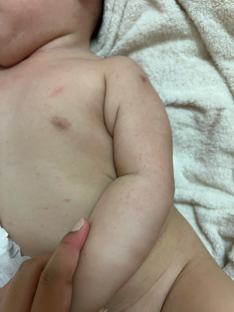 十個月寶寶全身起疹子