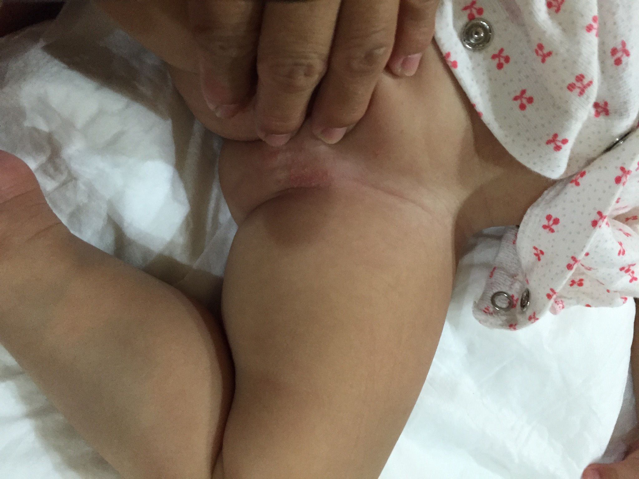 這是尿布疹還是過敏