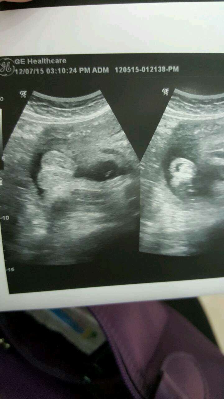 超音波一開始是女生，後來變男生？