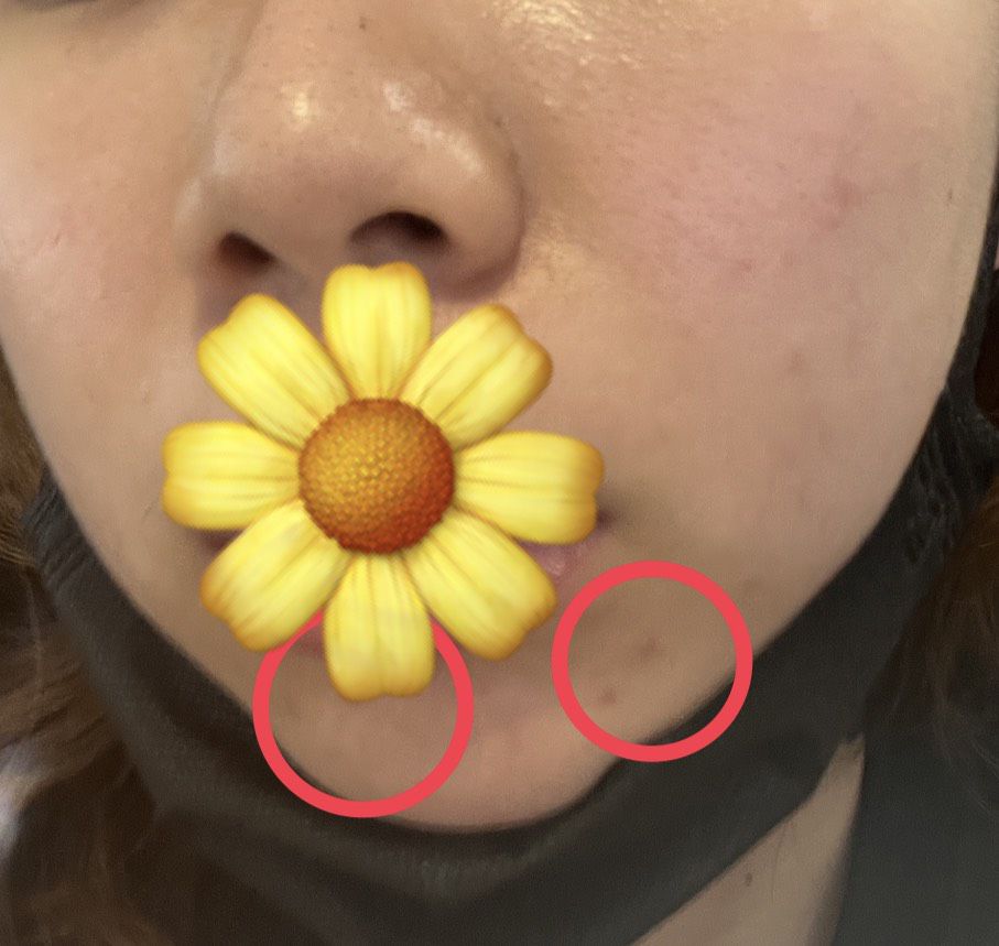 求在皮膚科打探索皮秒+超級鏡片的心得~