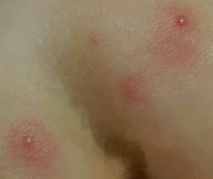 請問這是屬於尿布疹嗎？