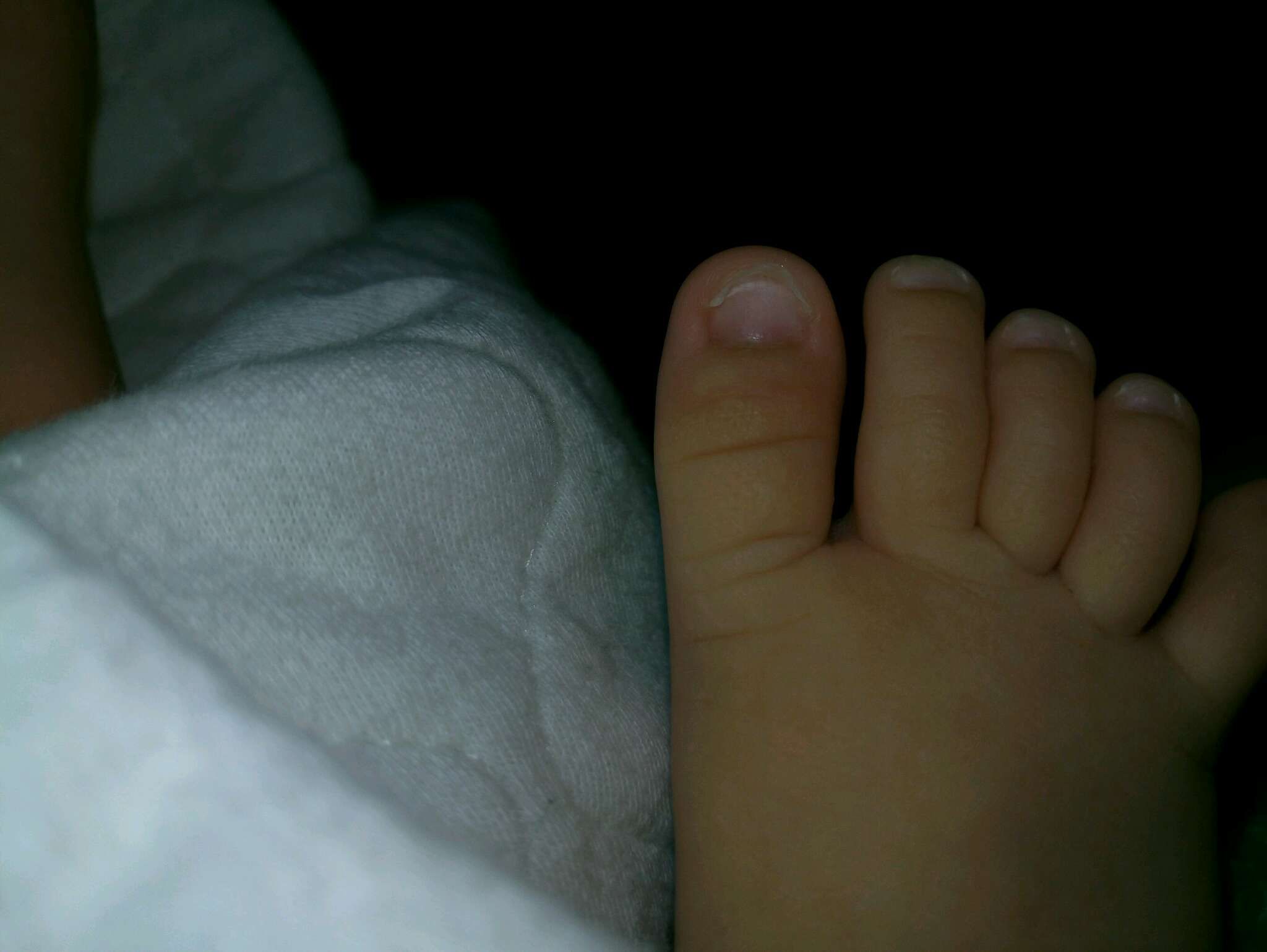 腳趾甲長出來往上捲