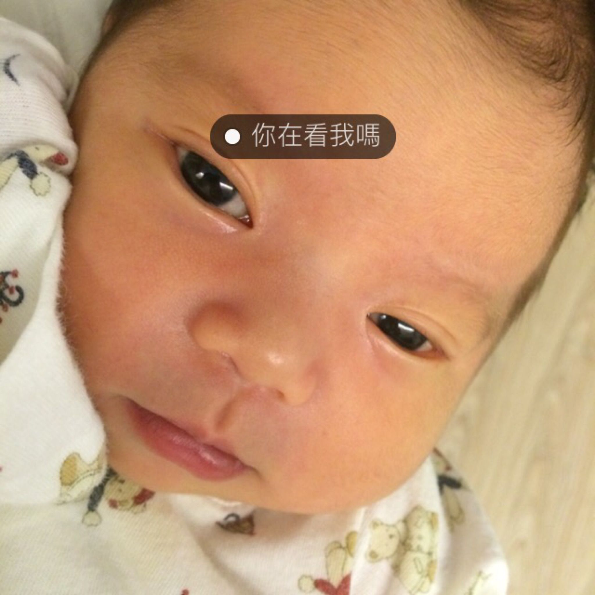 雙眼皮