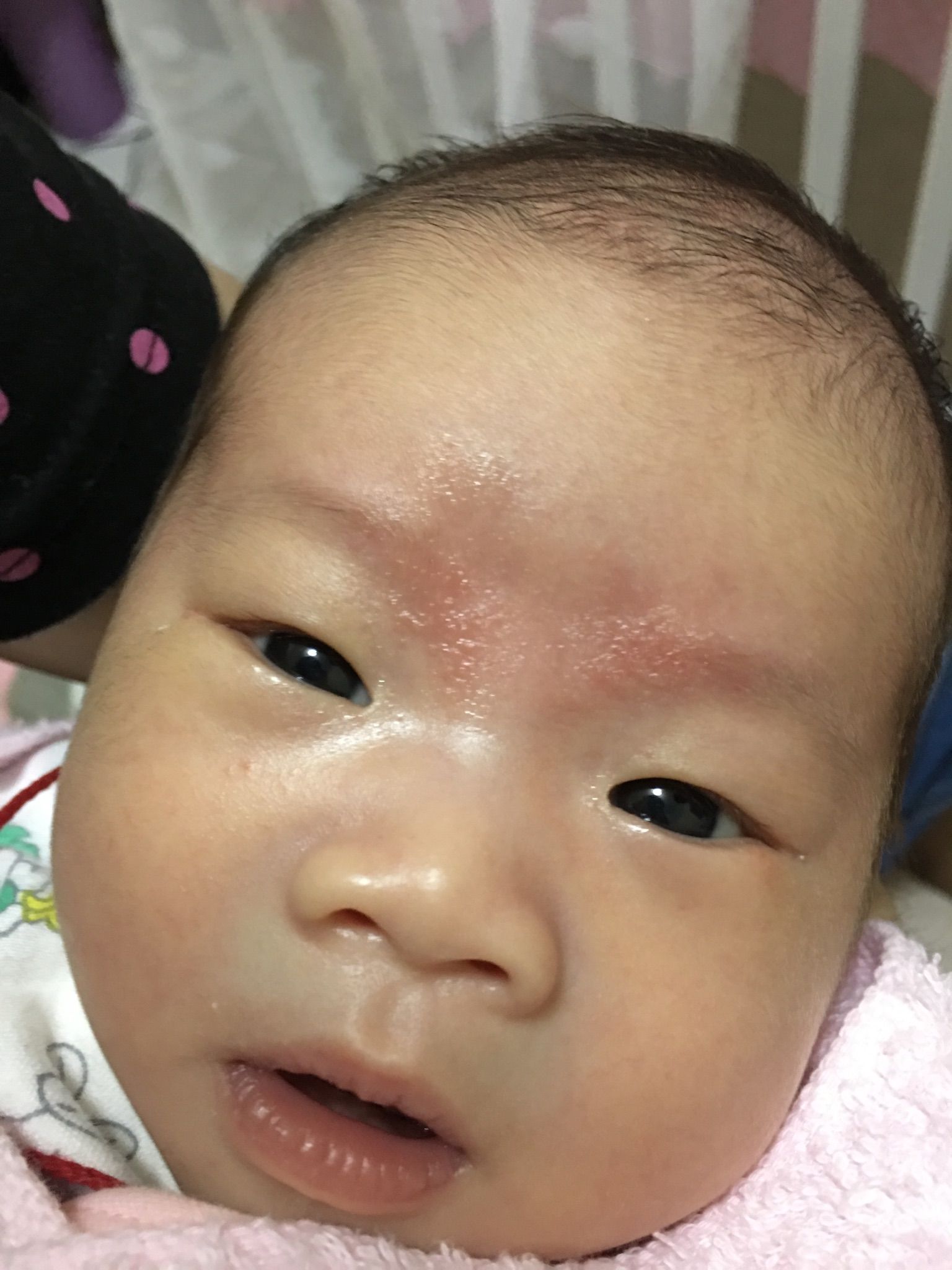 寶寶眉心起疹子