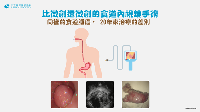 【李宜霖“胃”教時間】內視鏡手術-食道腫瘤20年來的治療差別
