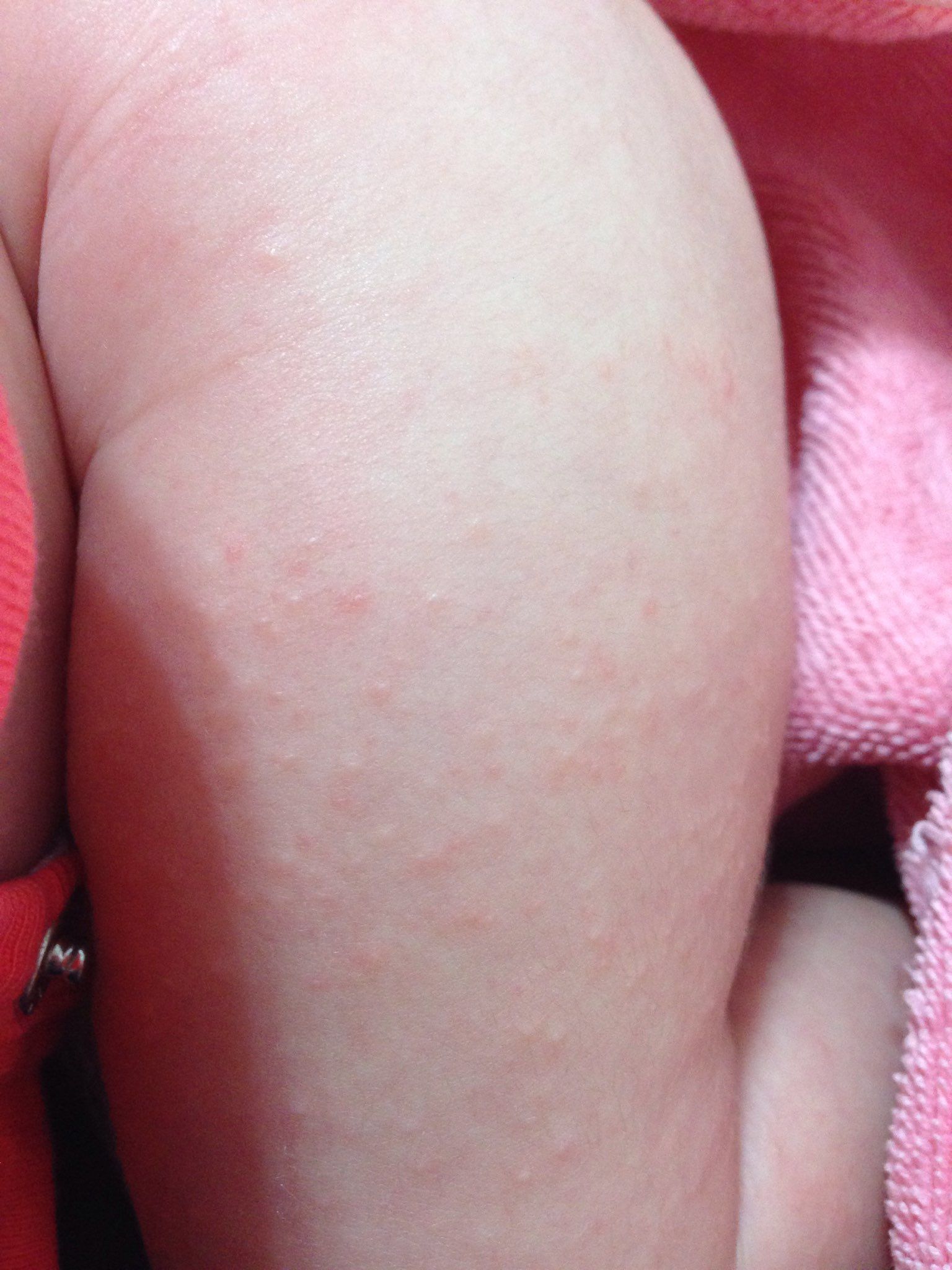 請問這是熱疹嗎？