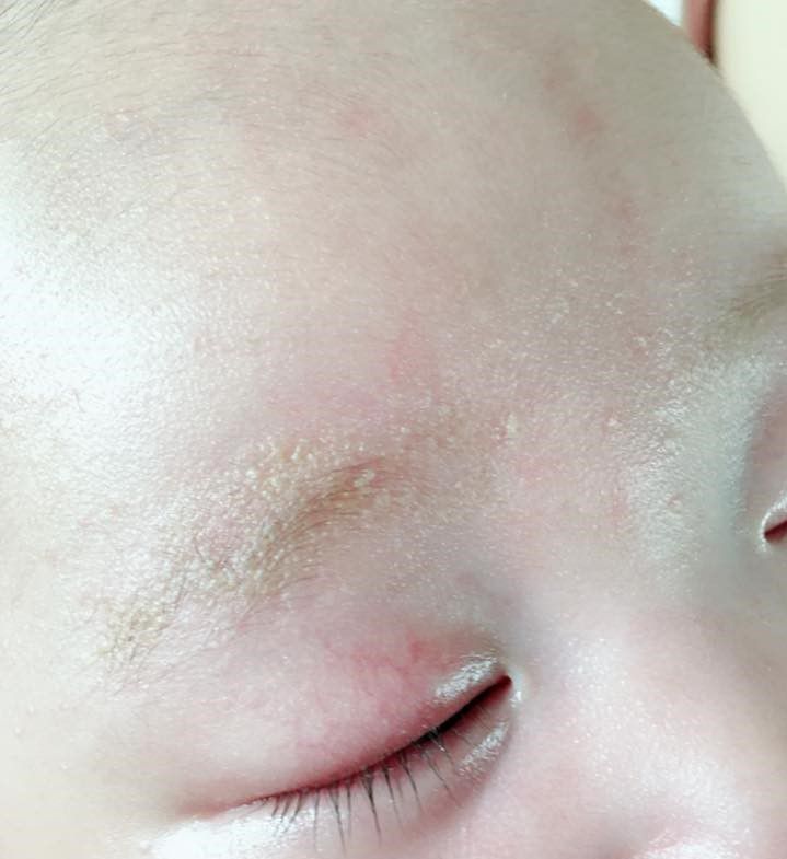 寶寶皮膚乾燥脫皮
