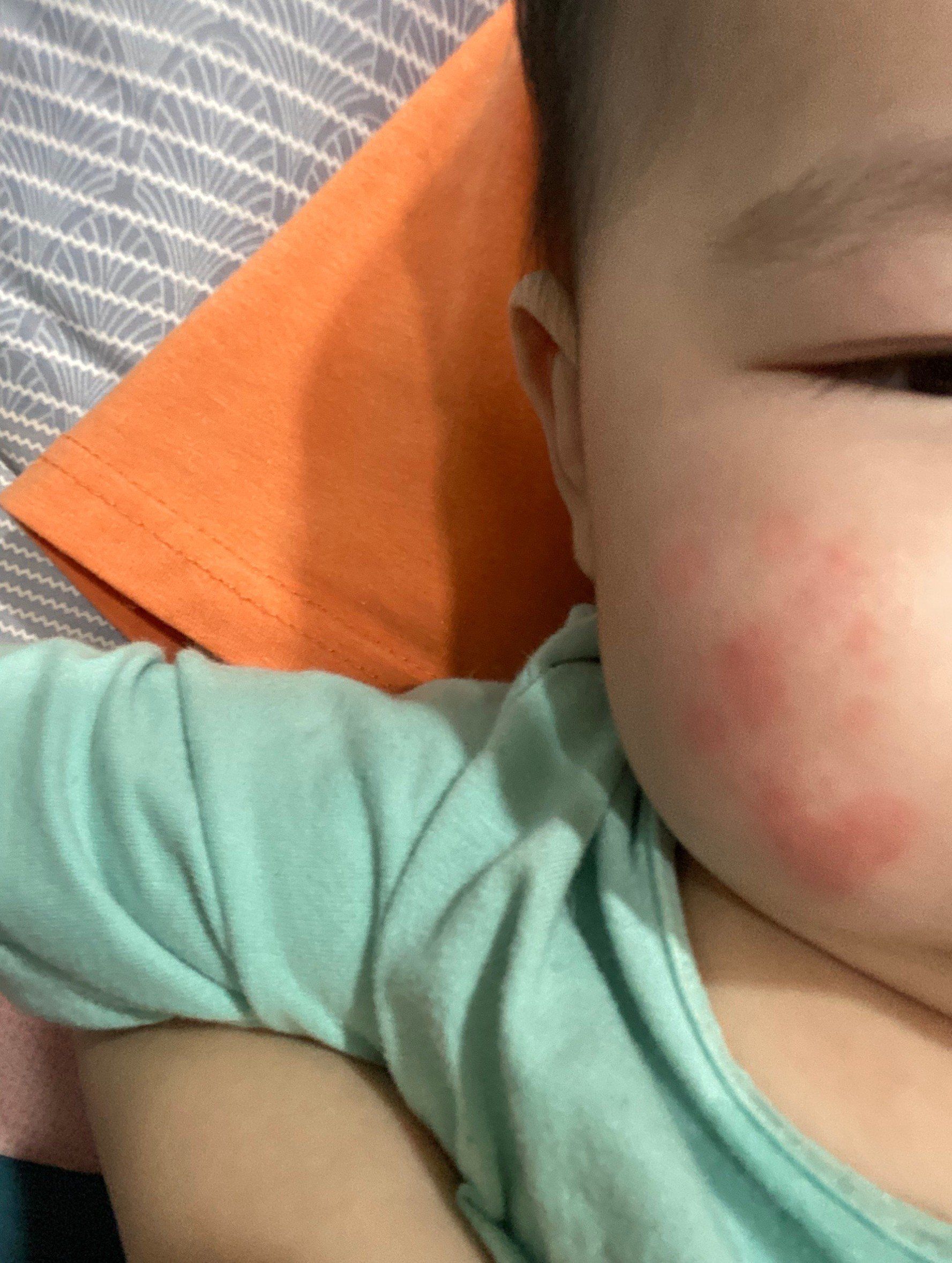 嫩嬰老是臉頰紅紅的 是過敏嗎?