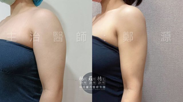推很楊氏的鄭醫師,她的技術很不錯
我是去抽手臂,手術後1個月恢復得不錯
明顯瘦了一些,效果很好~
