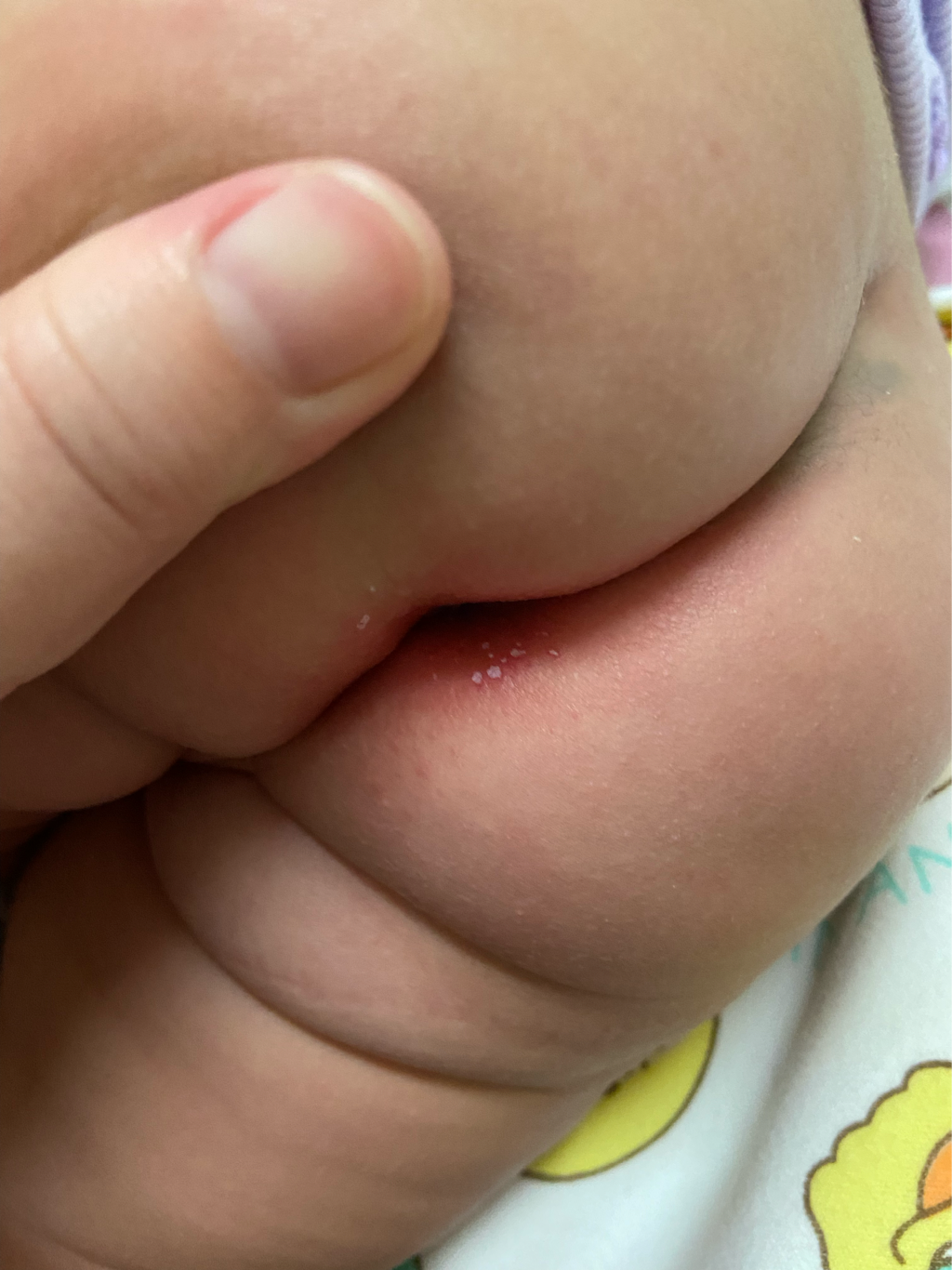 寶寶屁股這是怎麼了？