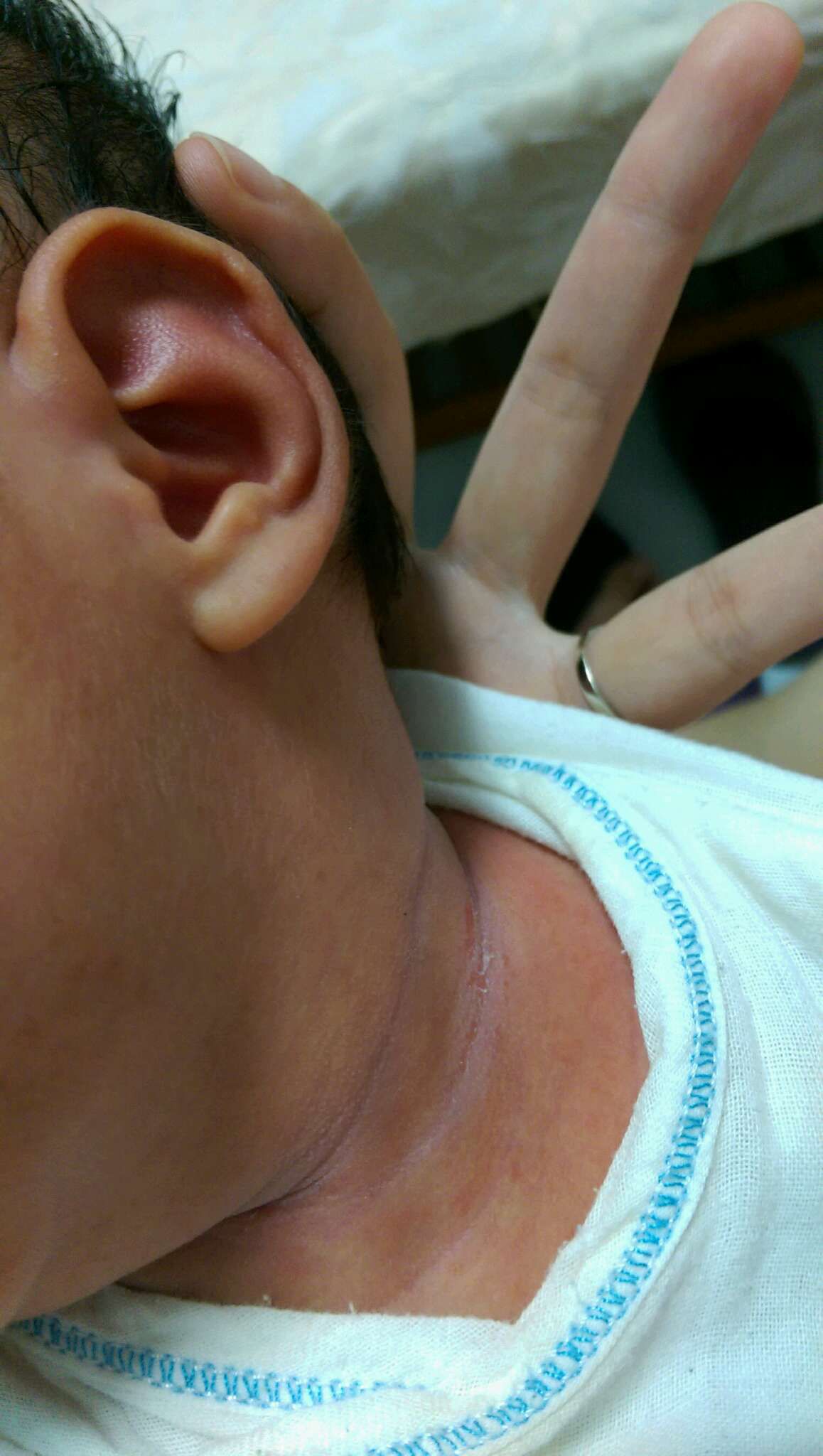 請問寶寶脖子縫隙有汗疹?