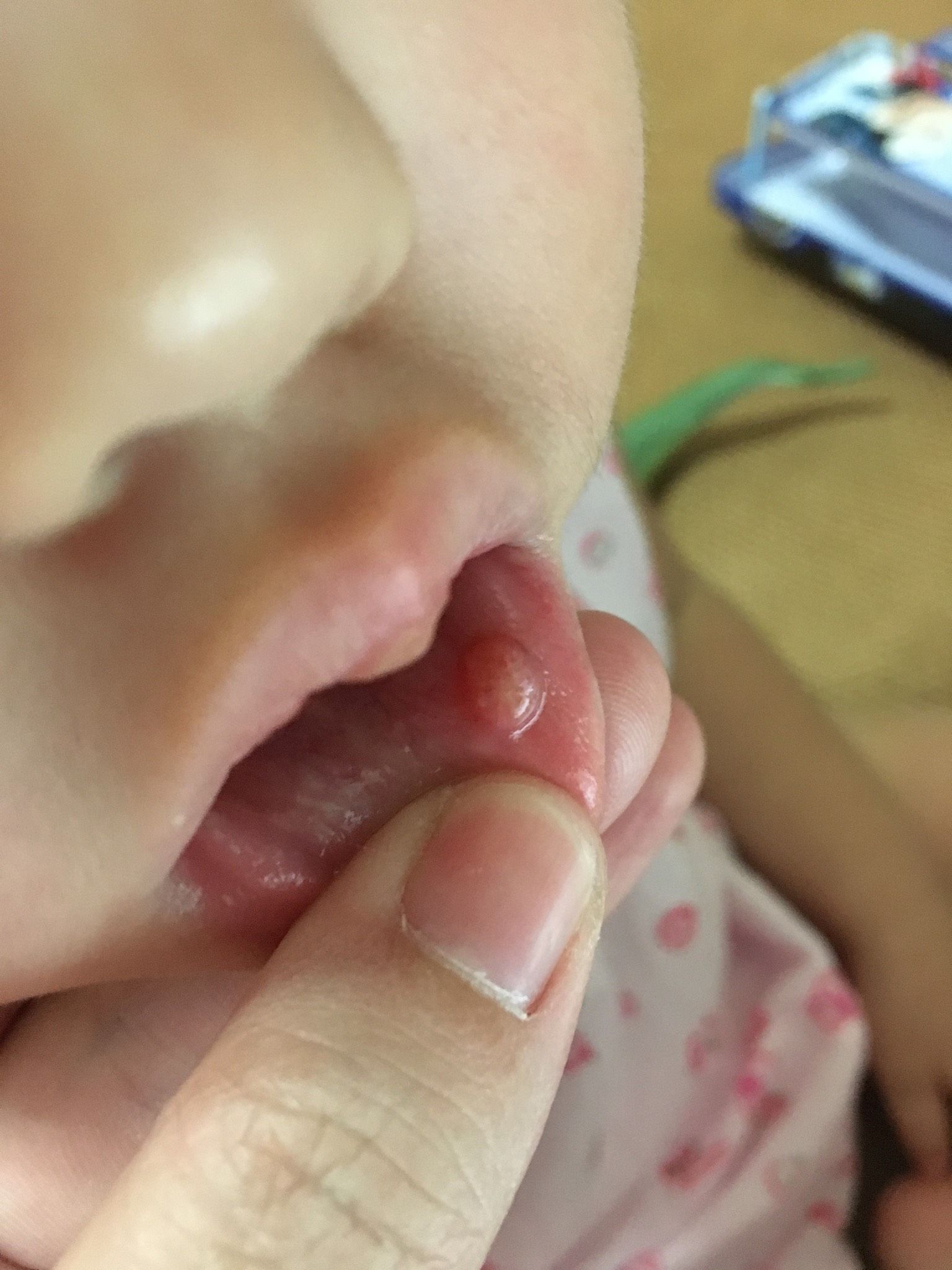 有沒有媽咪小朋友有唾液線囊腫的，可以分享一下經驗嗎？