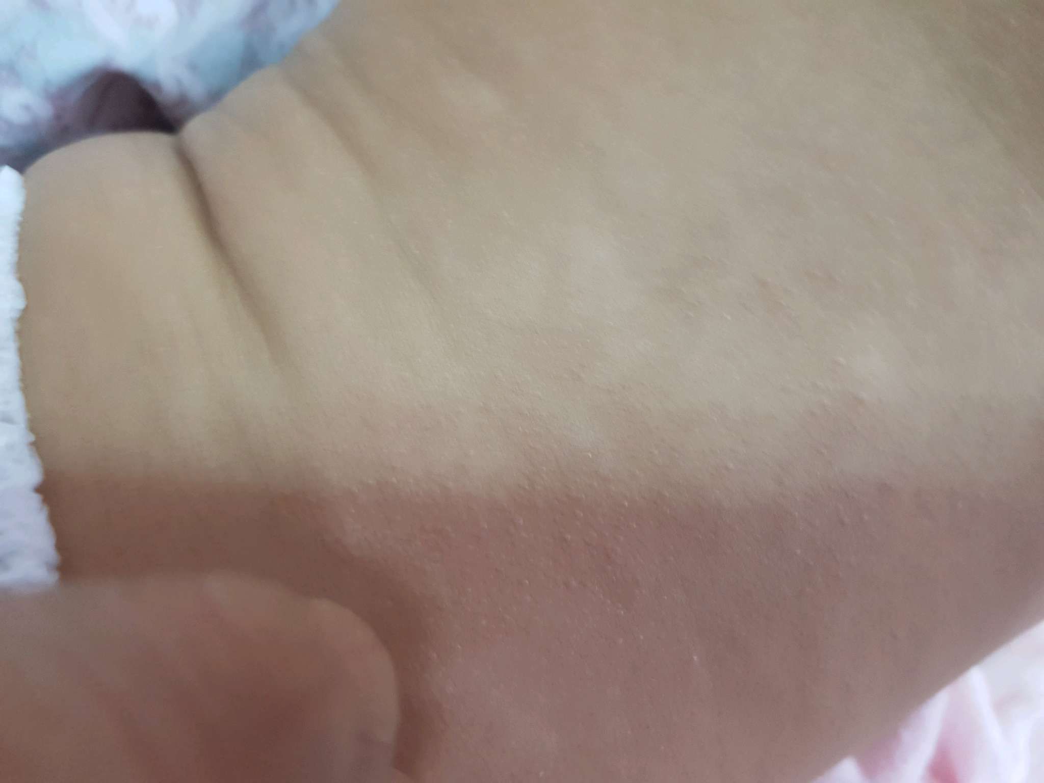 這是什麼疹子呢？
