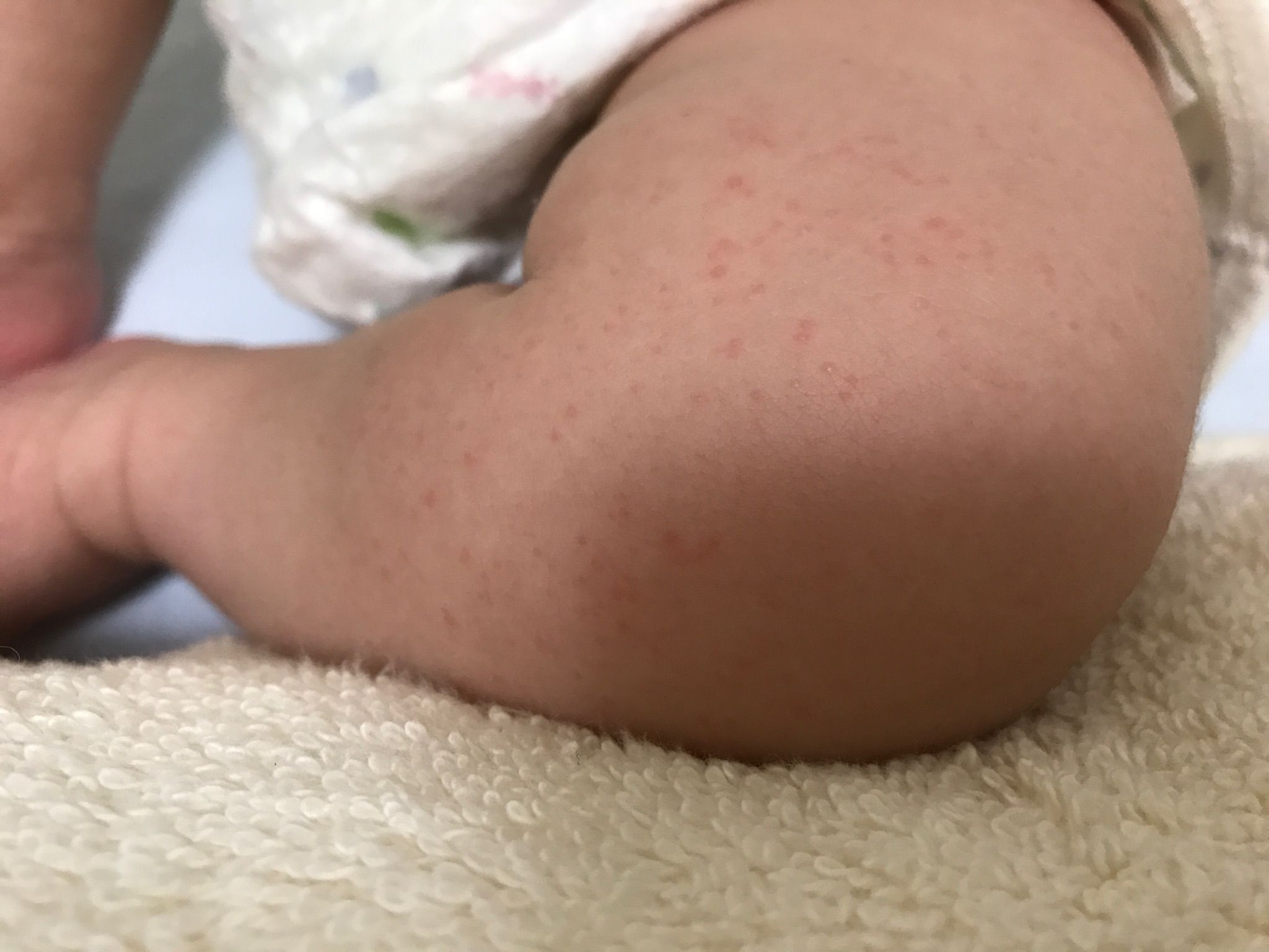 寶寶全身疹子該去看醫生嗎？