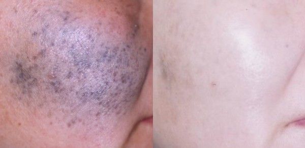 除斑的效果真的太讓人滿意了!!!