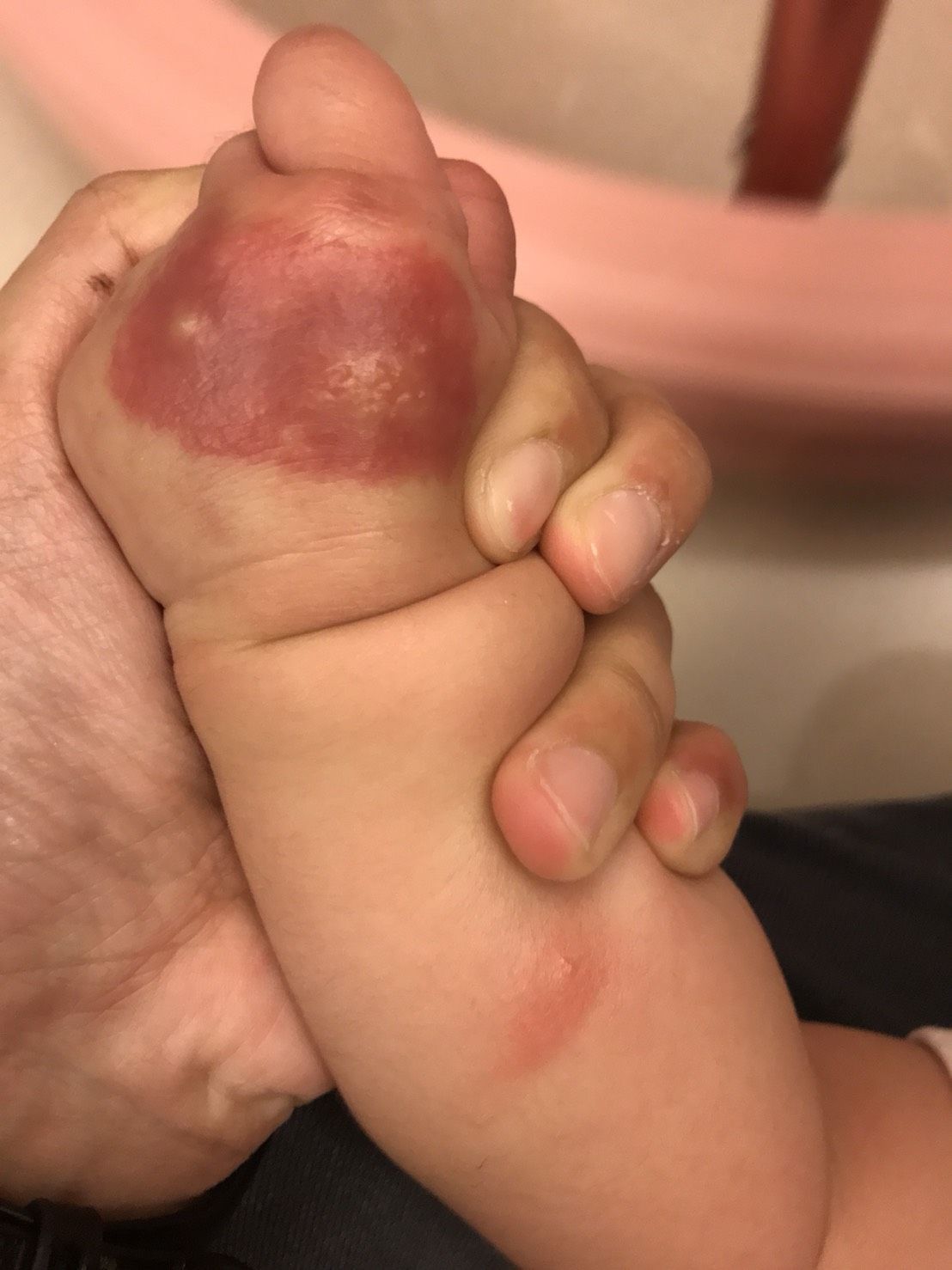 寶寶被小黑蚊咬到變成這樣正常嗎？