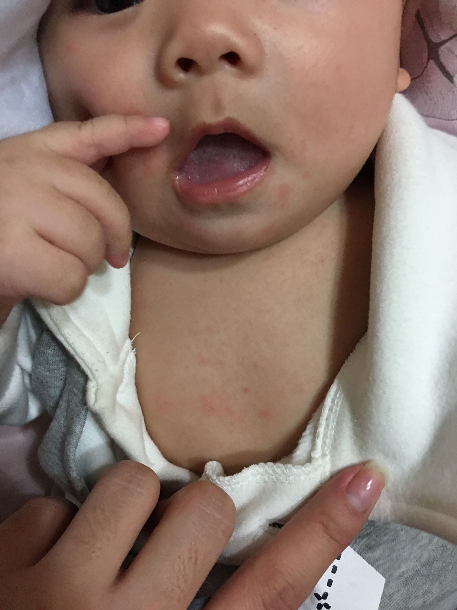寶寶4個月了皮膚出現紅疹子