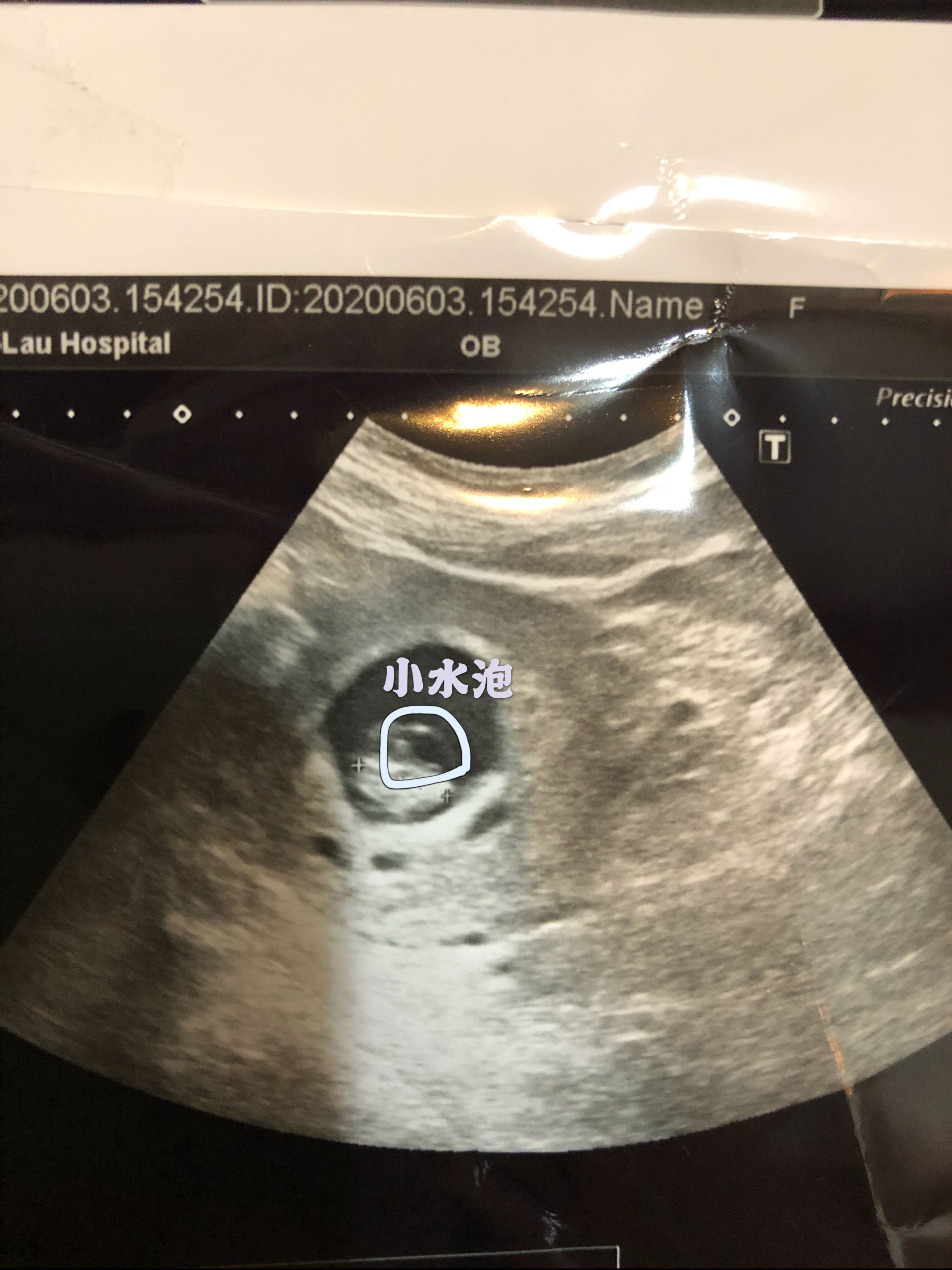 胚囊裡面被照有小水泡