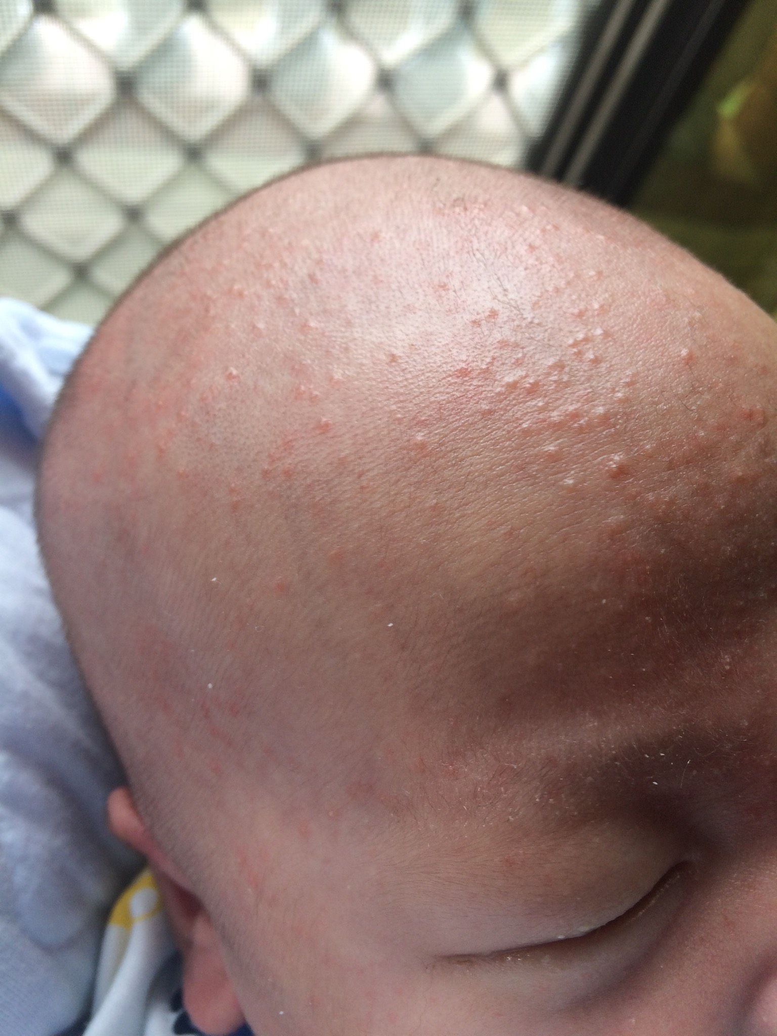 頭上臉上冒一粒粒的