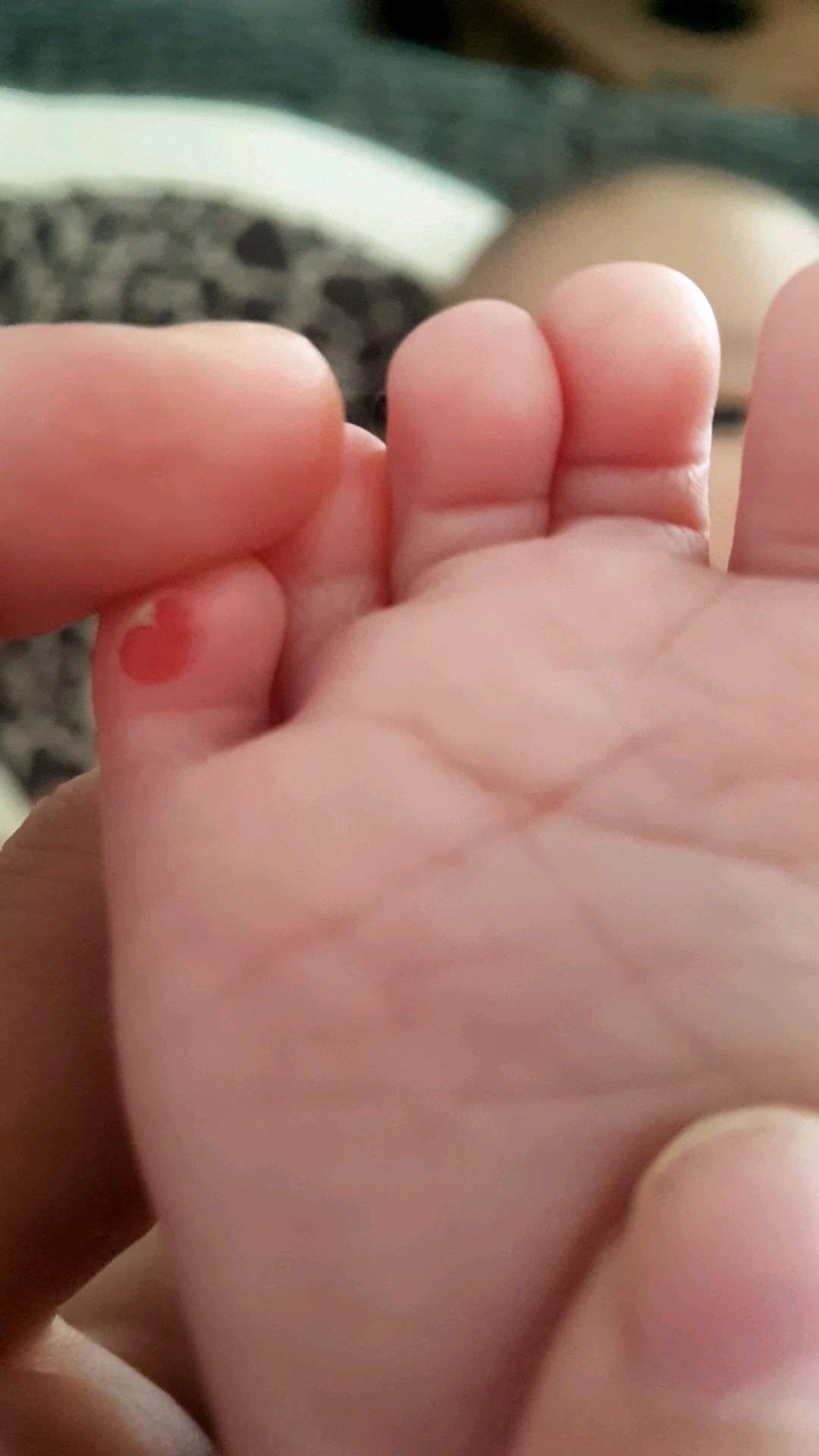 我的寶寶腳破皮該怎麼辦