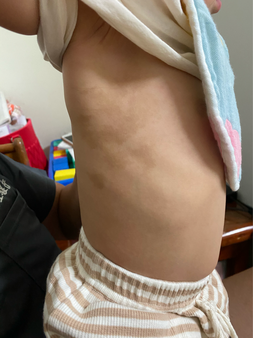 請問有媽咪知道寶寶皮膚怎麼會黑色素沈澱嗎？