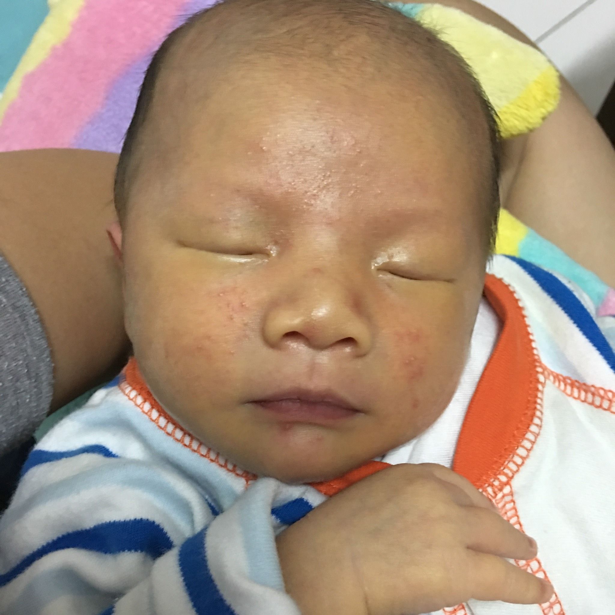 寶寶出生13天，臉上紅疹
