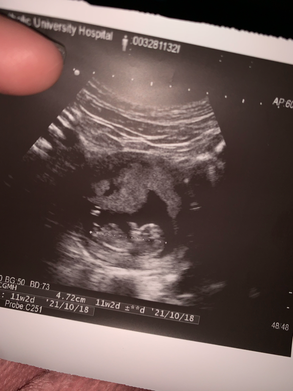 照超音波11週3天 媽咪愛 育兒問答