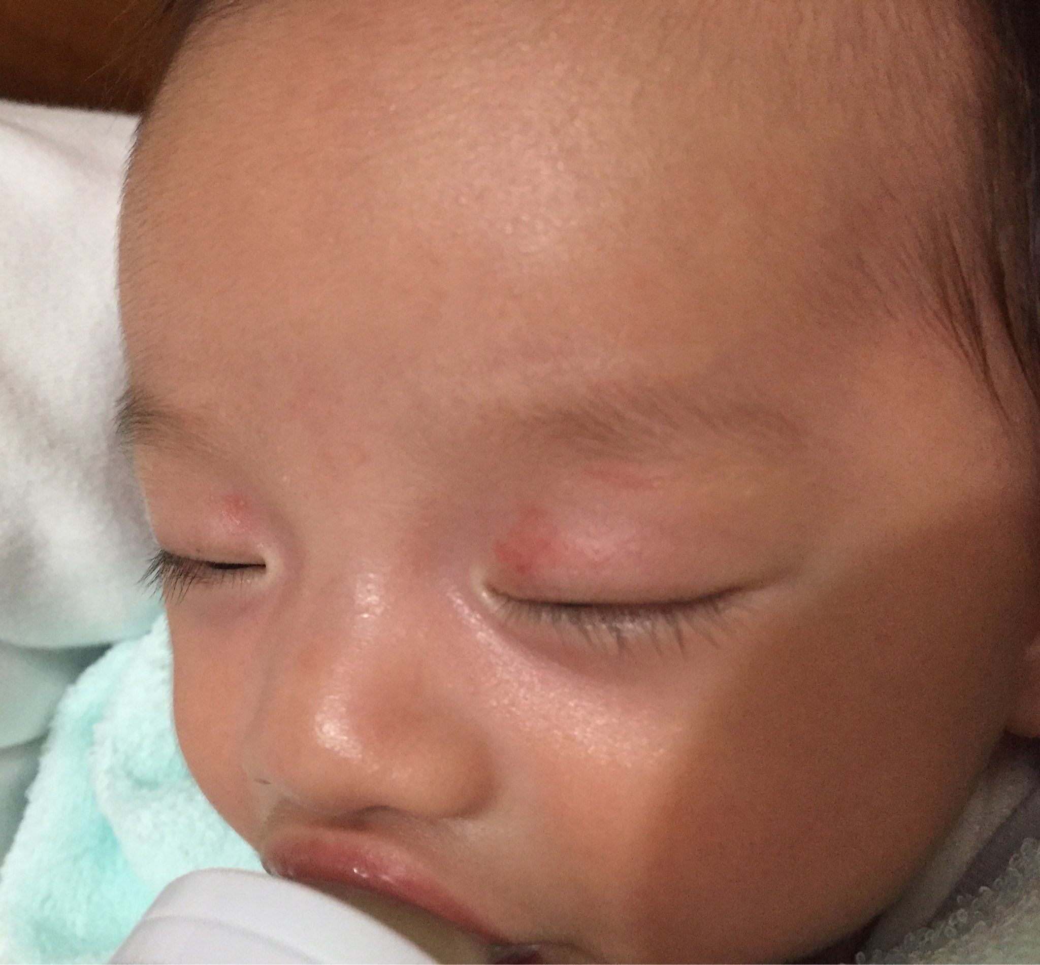 寶寶眼皮上有紅疹