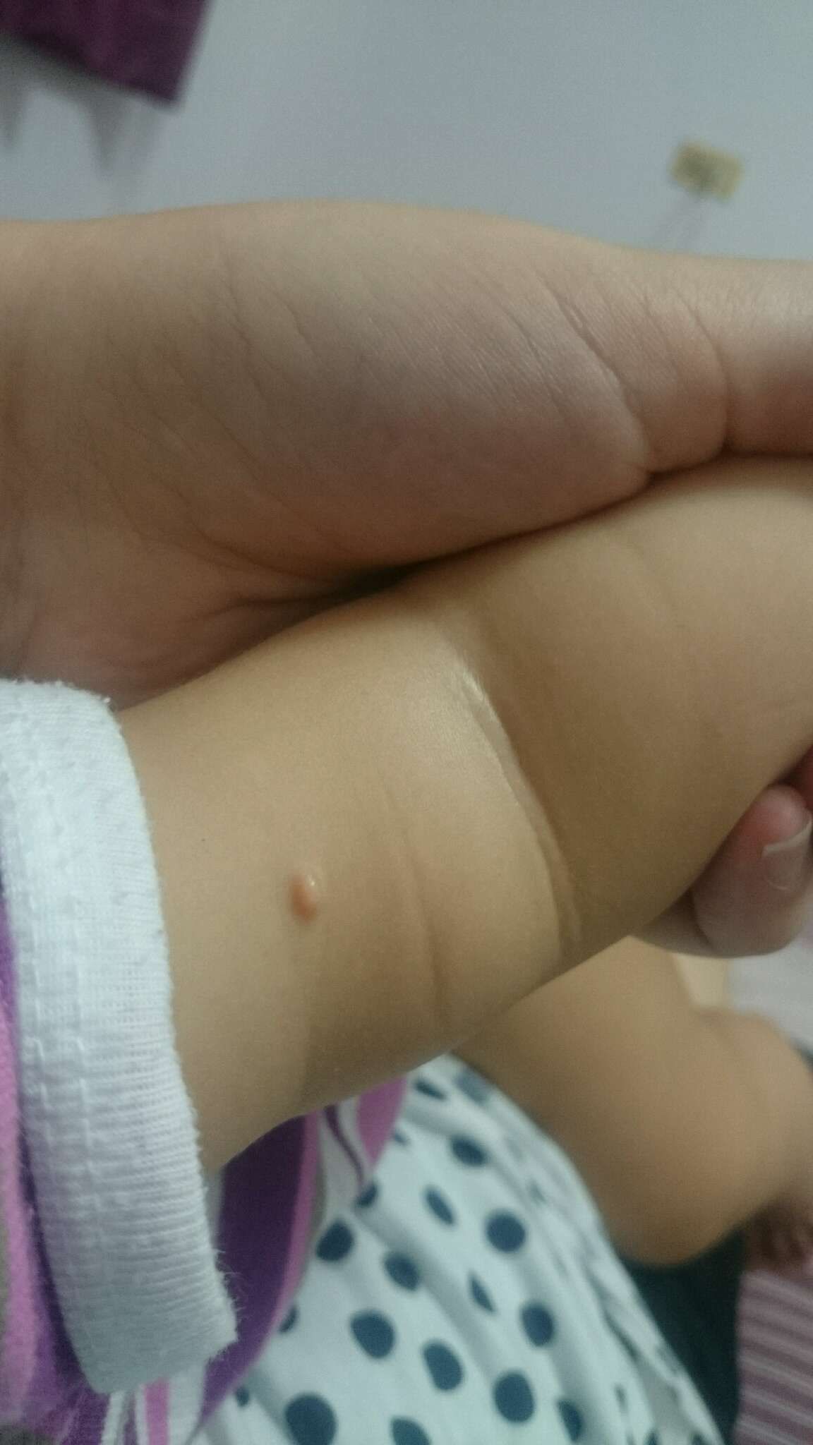 手臂上長了一顆&hellip;