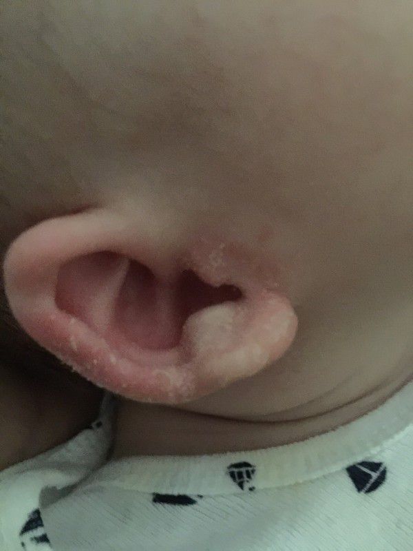 寶寶耳朵怎麼了