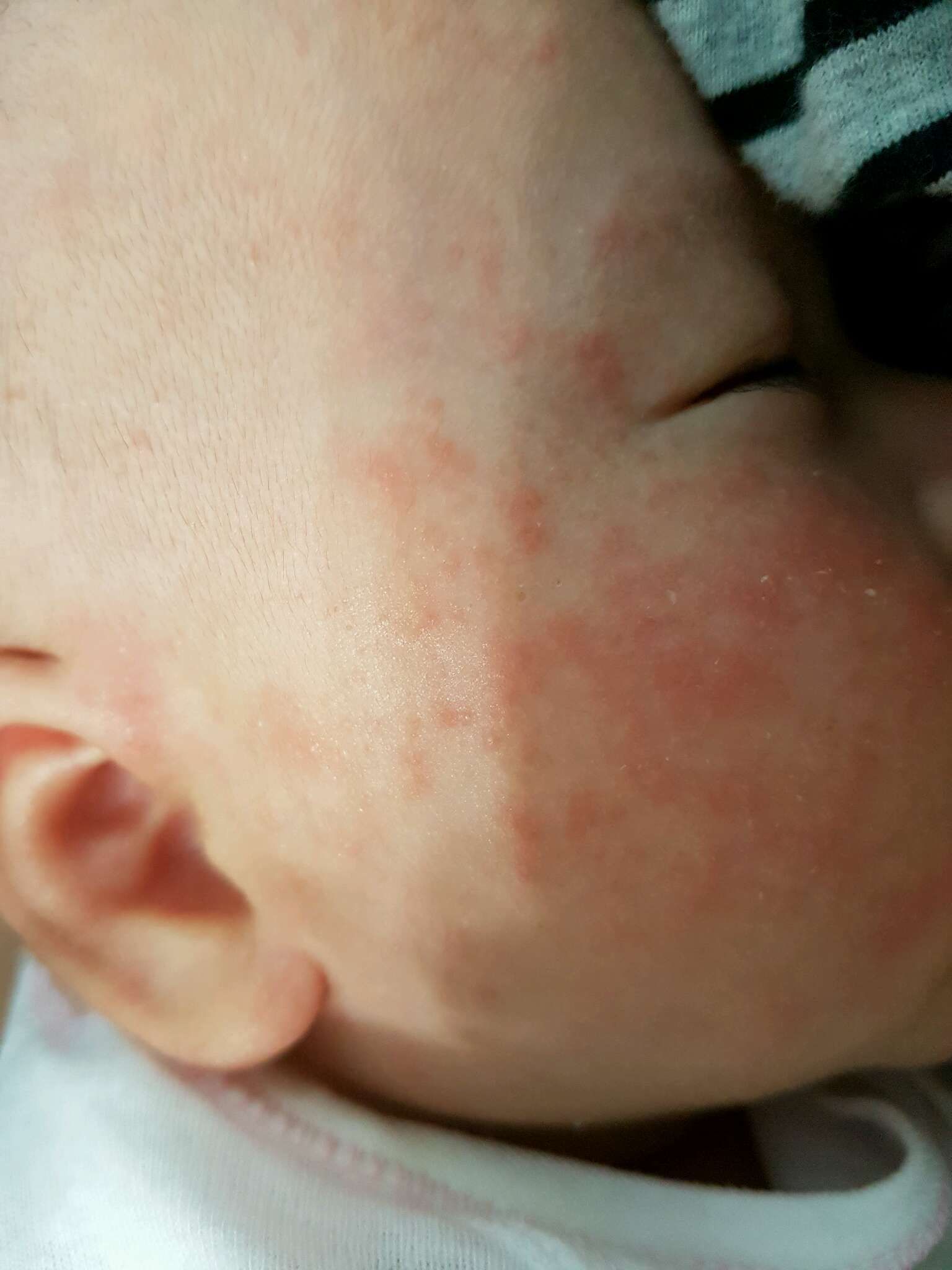 寶寶臉上紅紅是熱疹嗎？