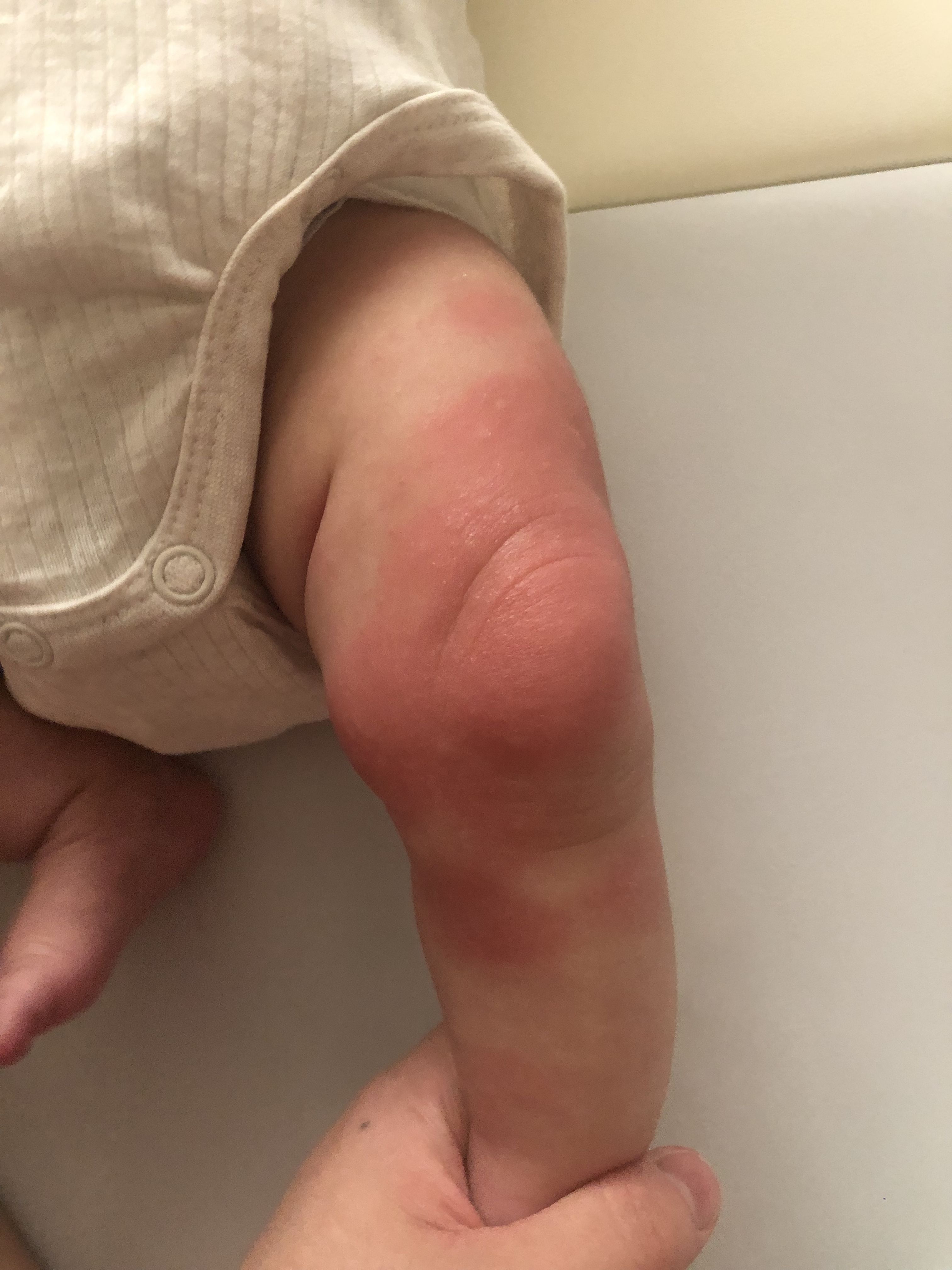 寶寶突然皮膚一大片紅腫過敏