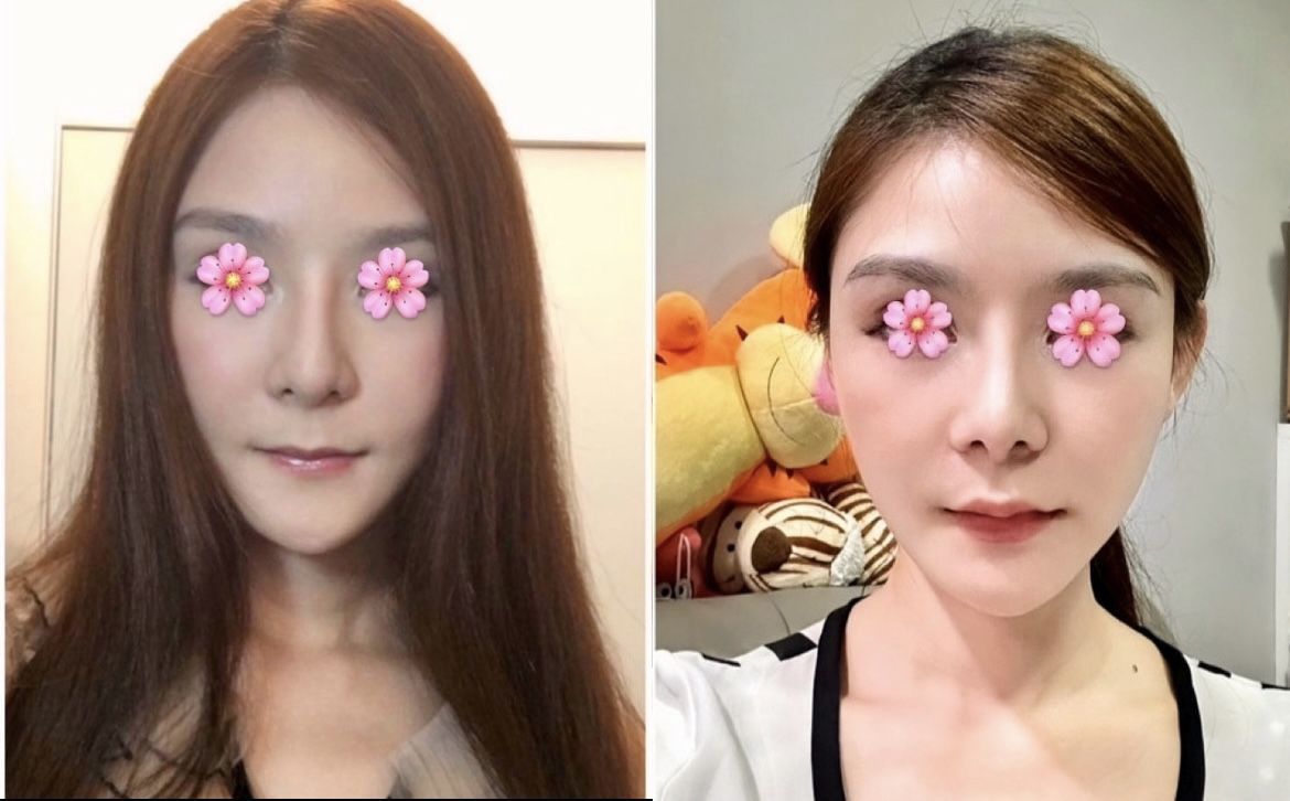 嘴唇感覺老了變薄 嘗試緹奧希玻尿酸拯救