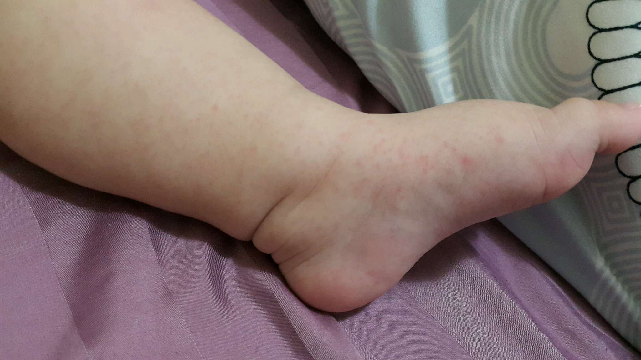 寶寶的腳、腿、屁屁、身體都紅紅的一點一點