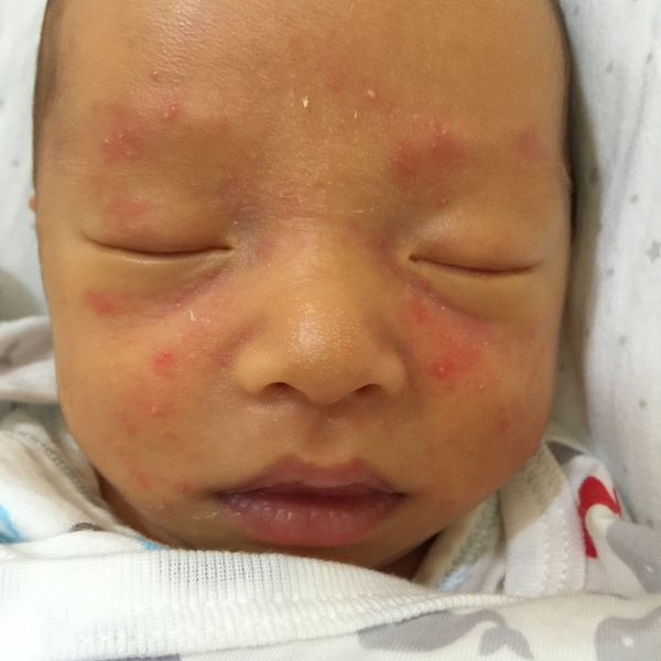 臉上皮膚 媽咪愛 育兒問答