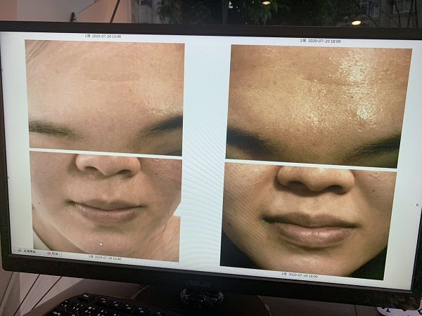 做胜肽水光 皮膚真的變好多!
