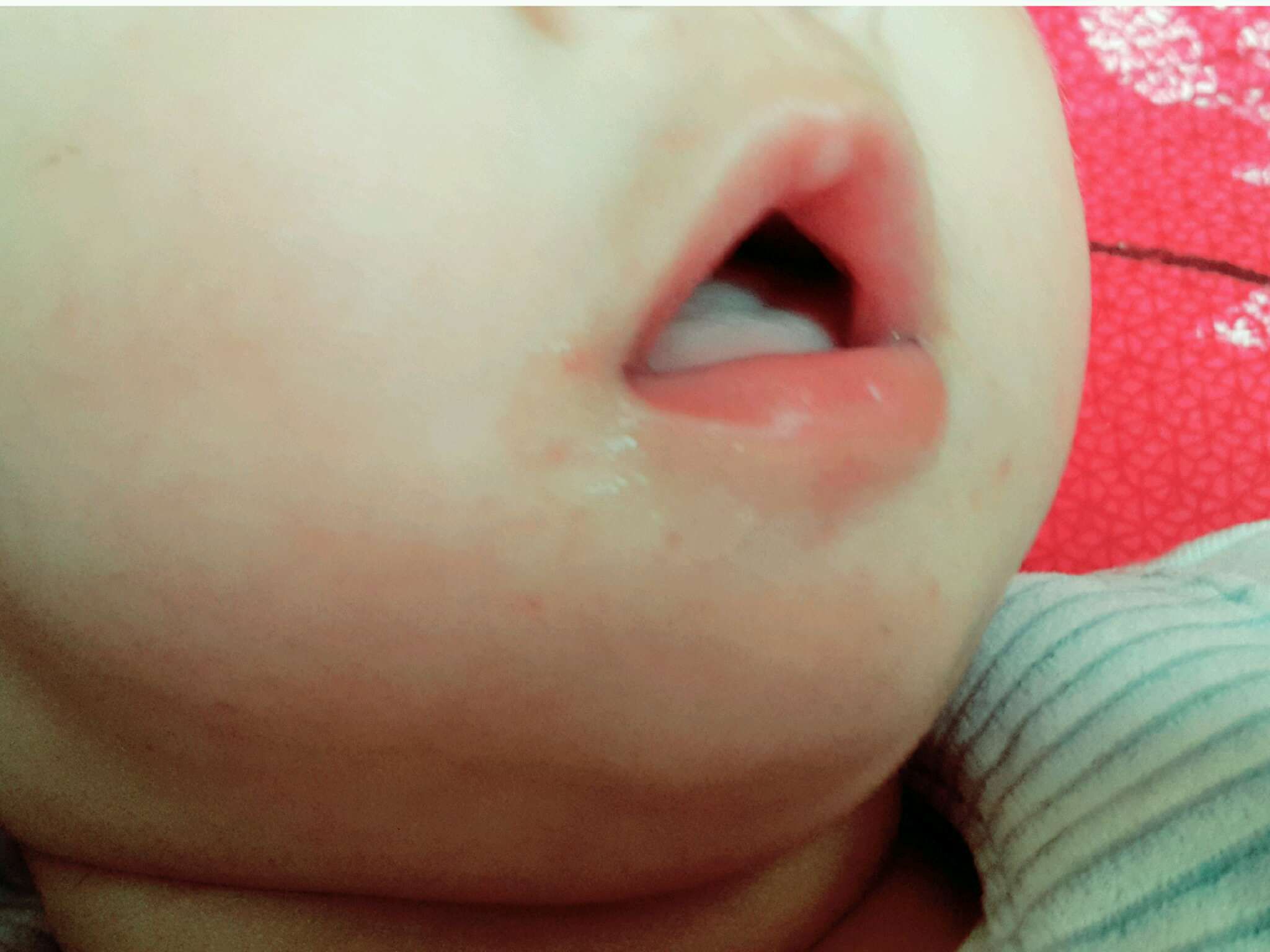 請問這是口水疹嗎？