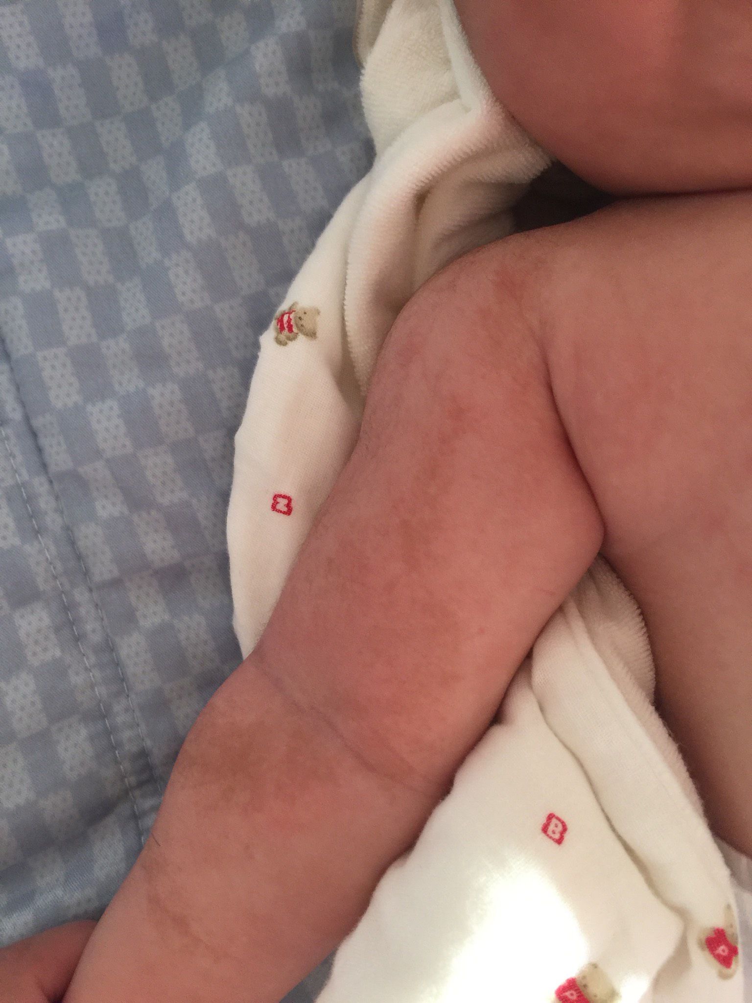 手臂皮膚有咖啡色斑