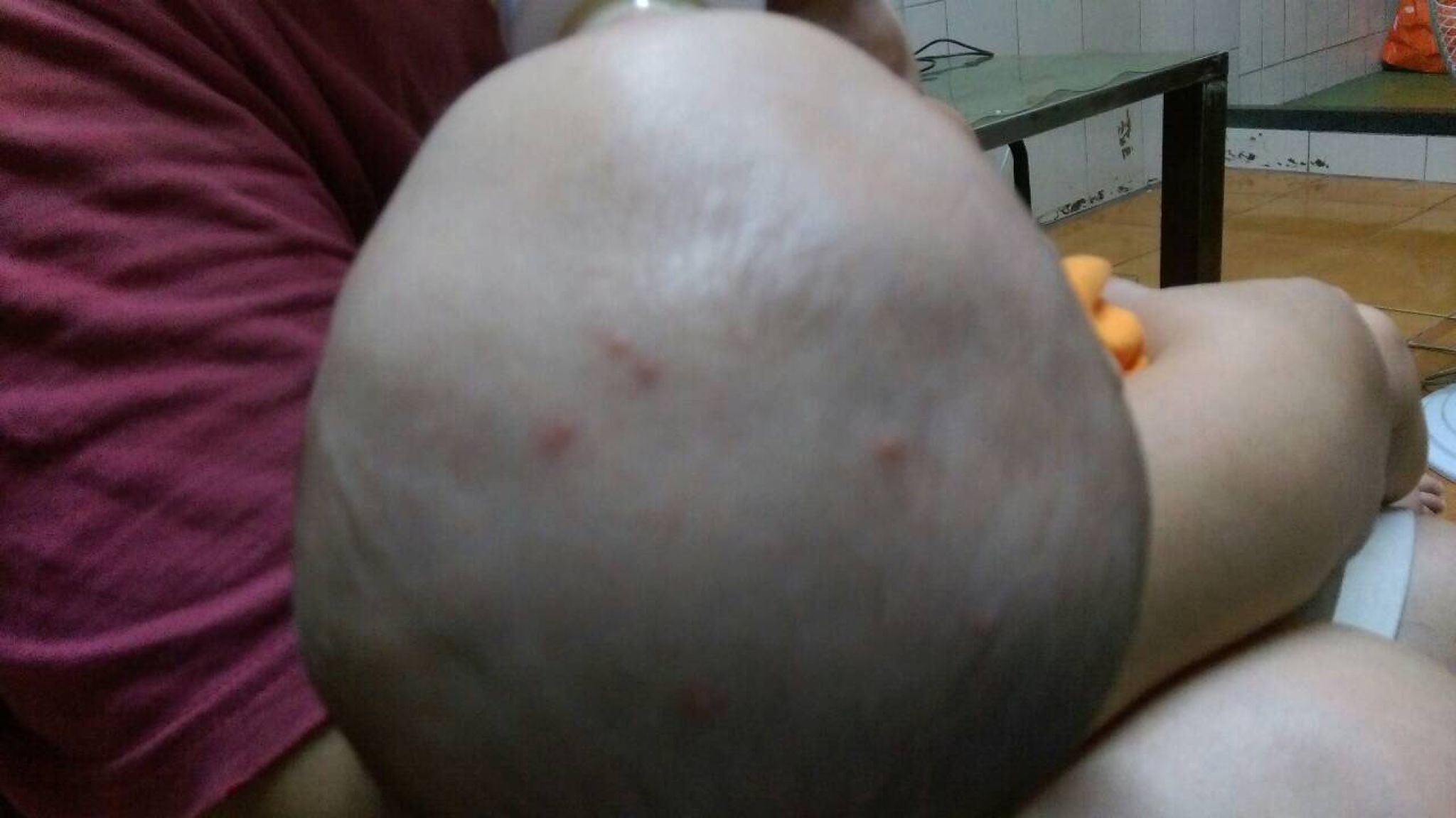 請問4個多月寶寶頭部被蚊子叮，可以擦什麼？