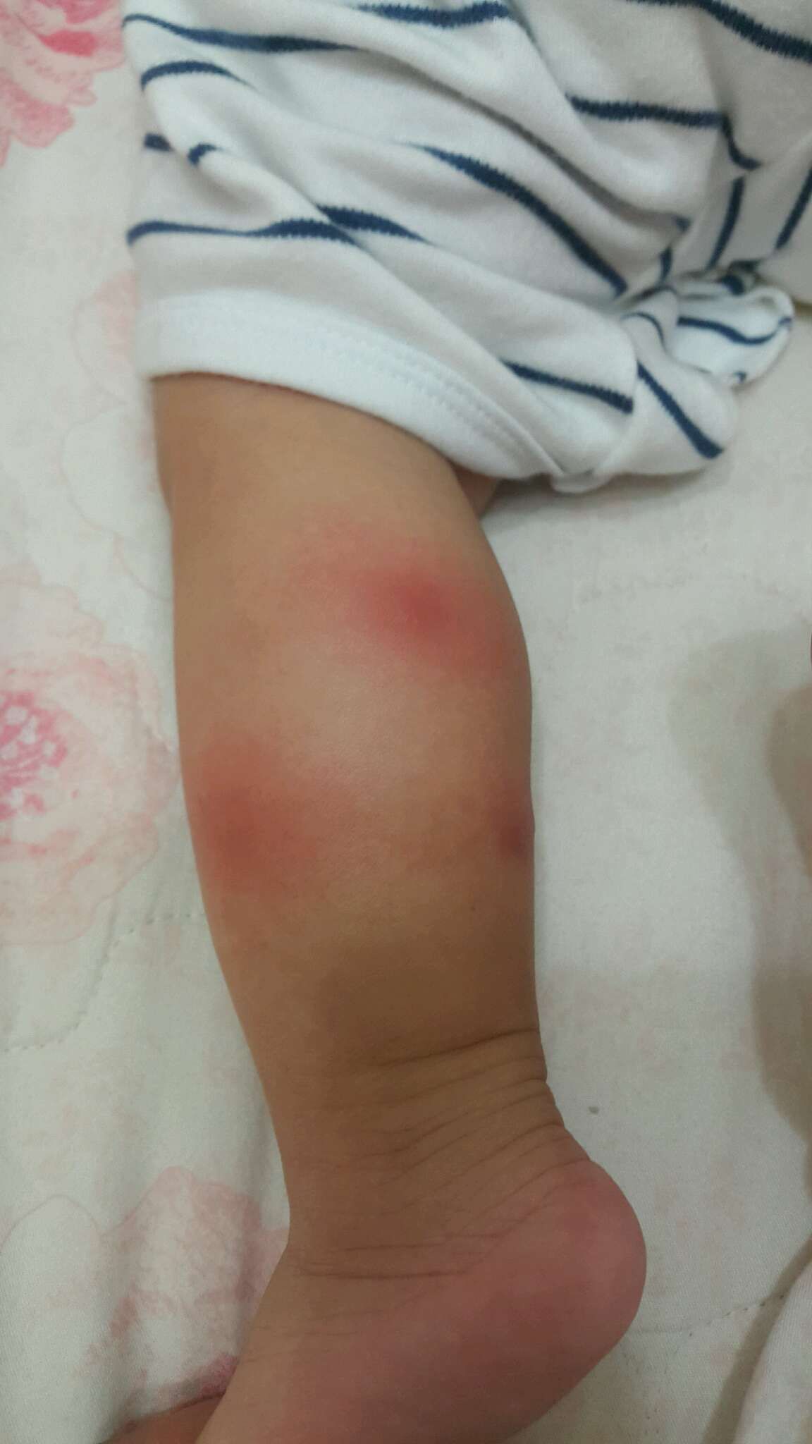 想請問媽咪們~這是被蚊子叮?還是被蟲咬?